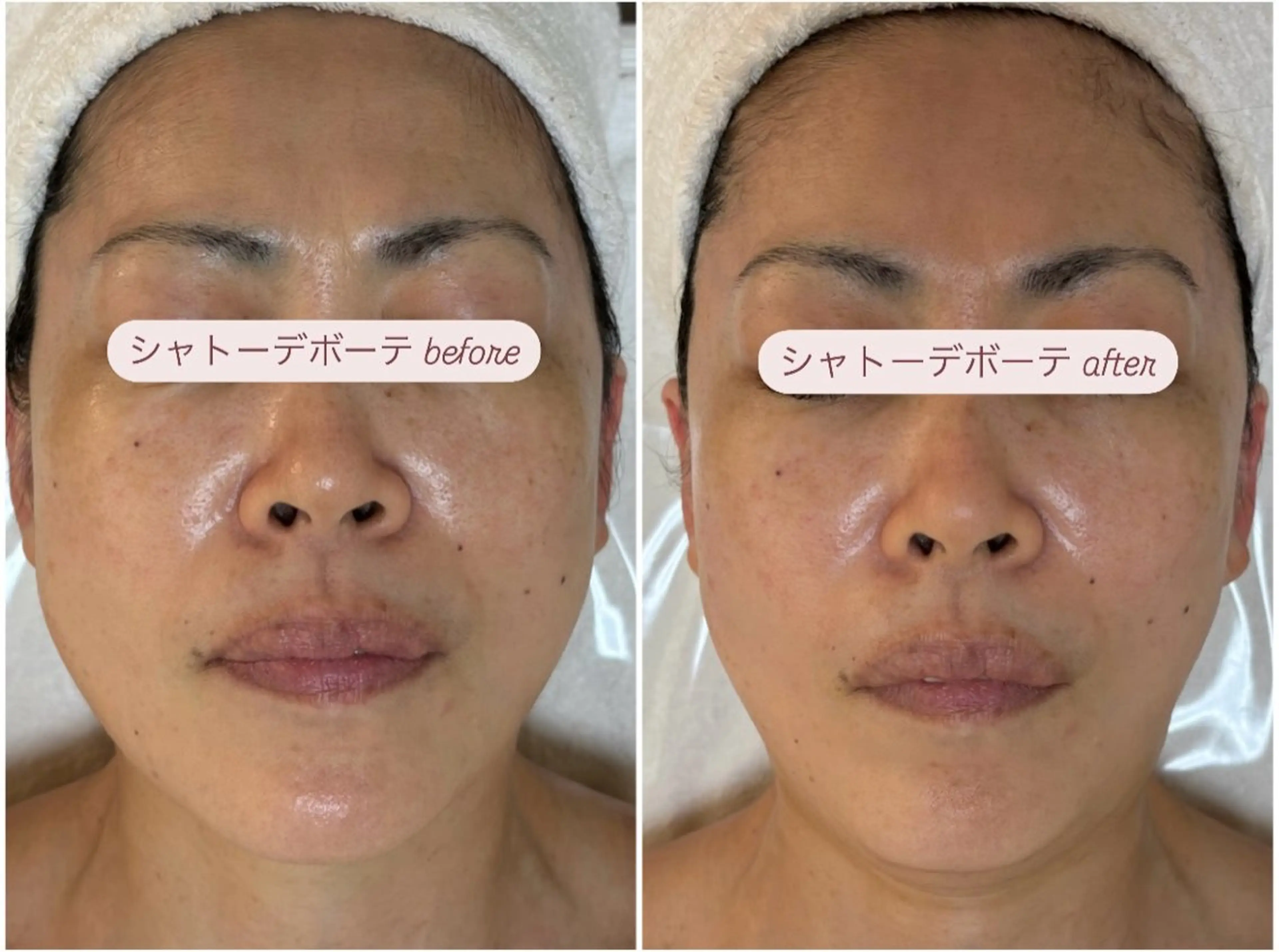 エステ 肌質改善|天王寺 For...はるかのエステ・リラクイメージ