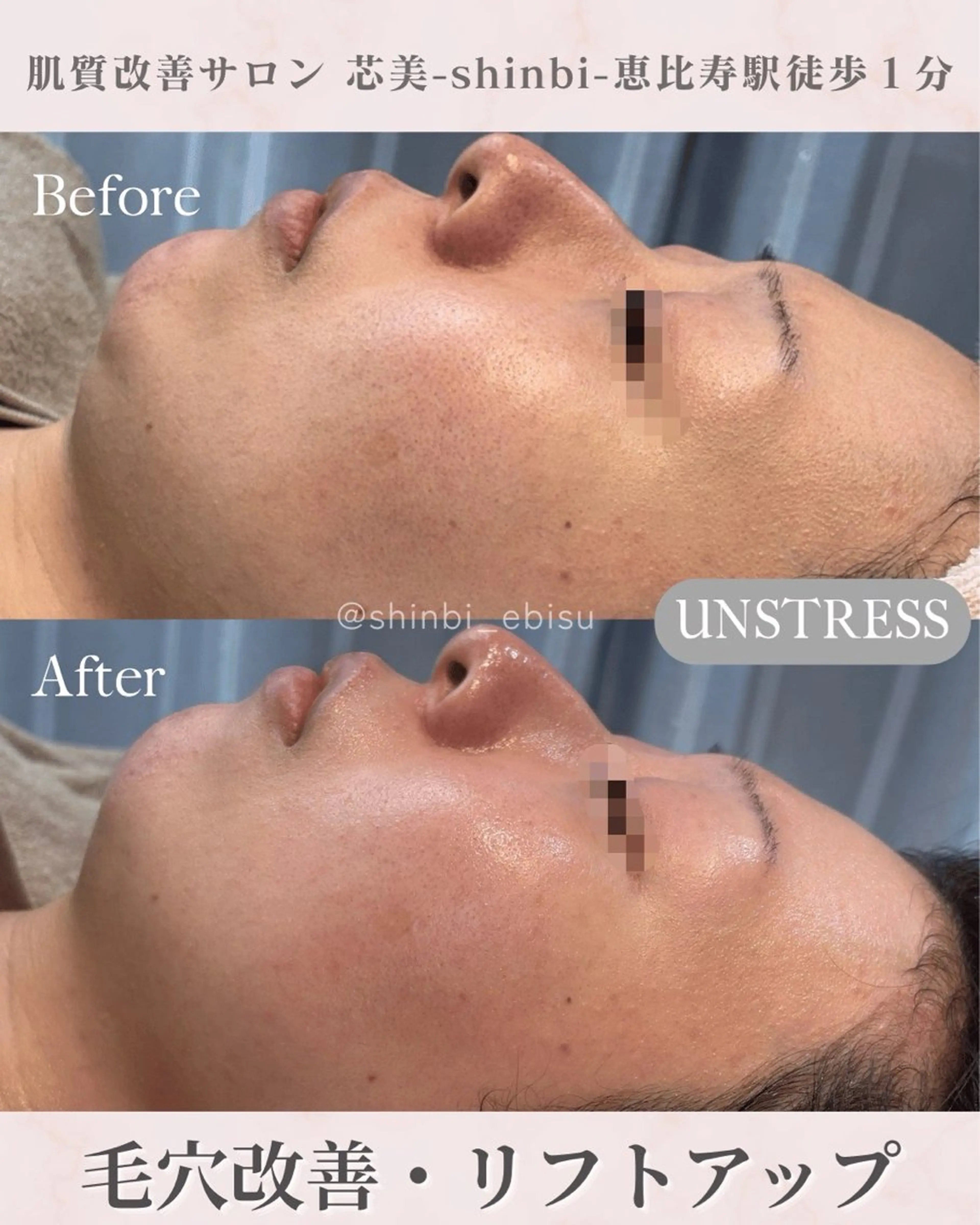 エステ 芯美-shinbi-所属・EMI/モニター募集 ニキビ/毛穴/しわのエステ・リラクイメージ