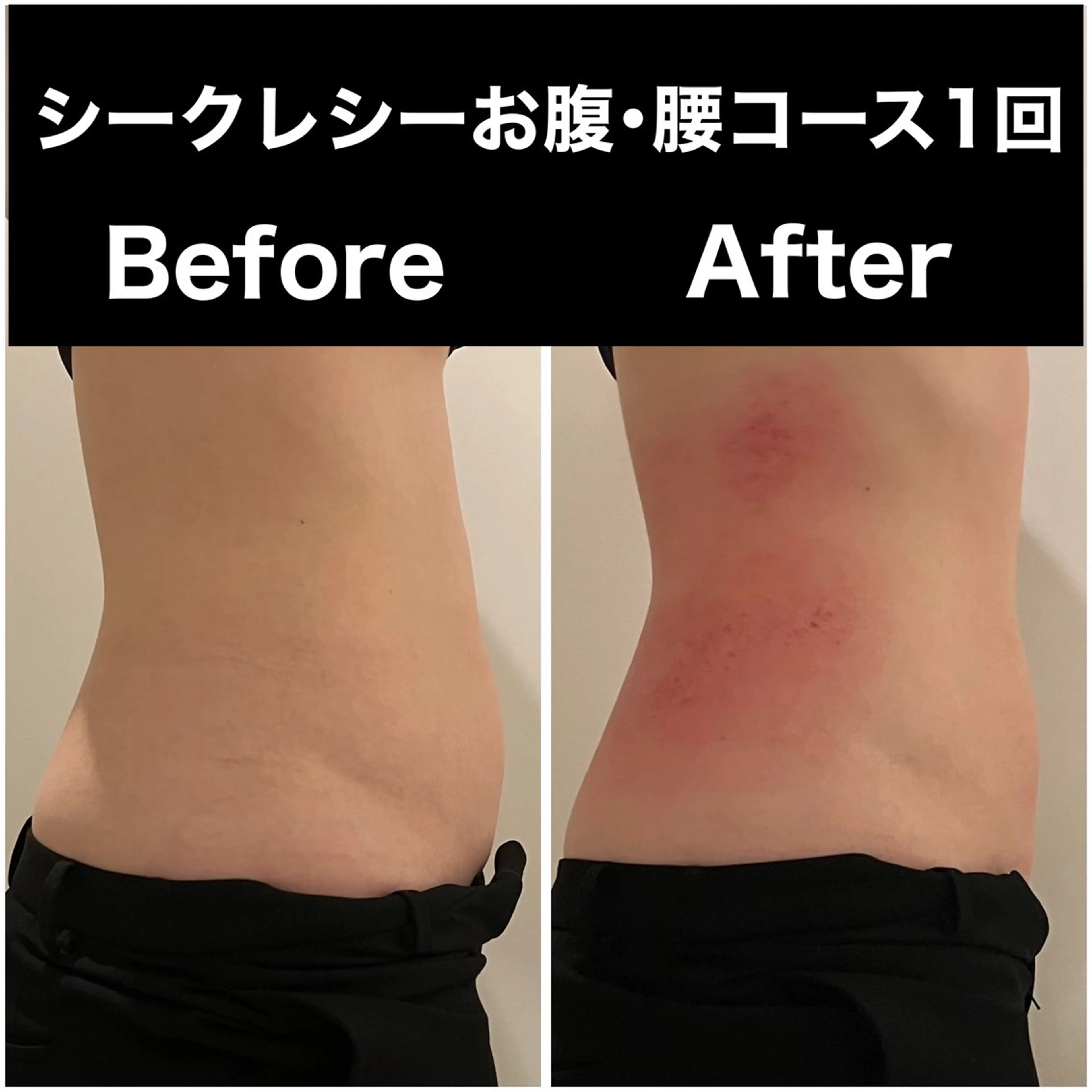 【ビフォアフ撮影モデル🤳🏻💖】シークレシー ×リンパマッサージ 部分集中60分⚡️の写真