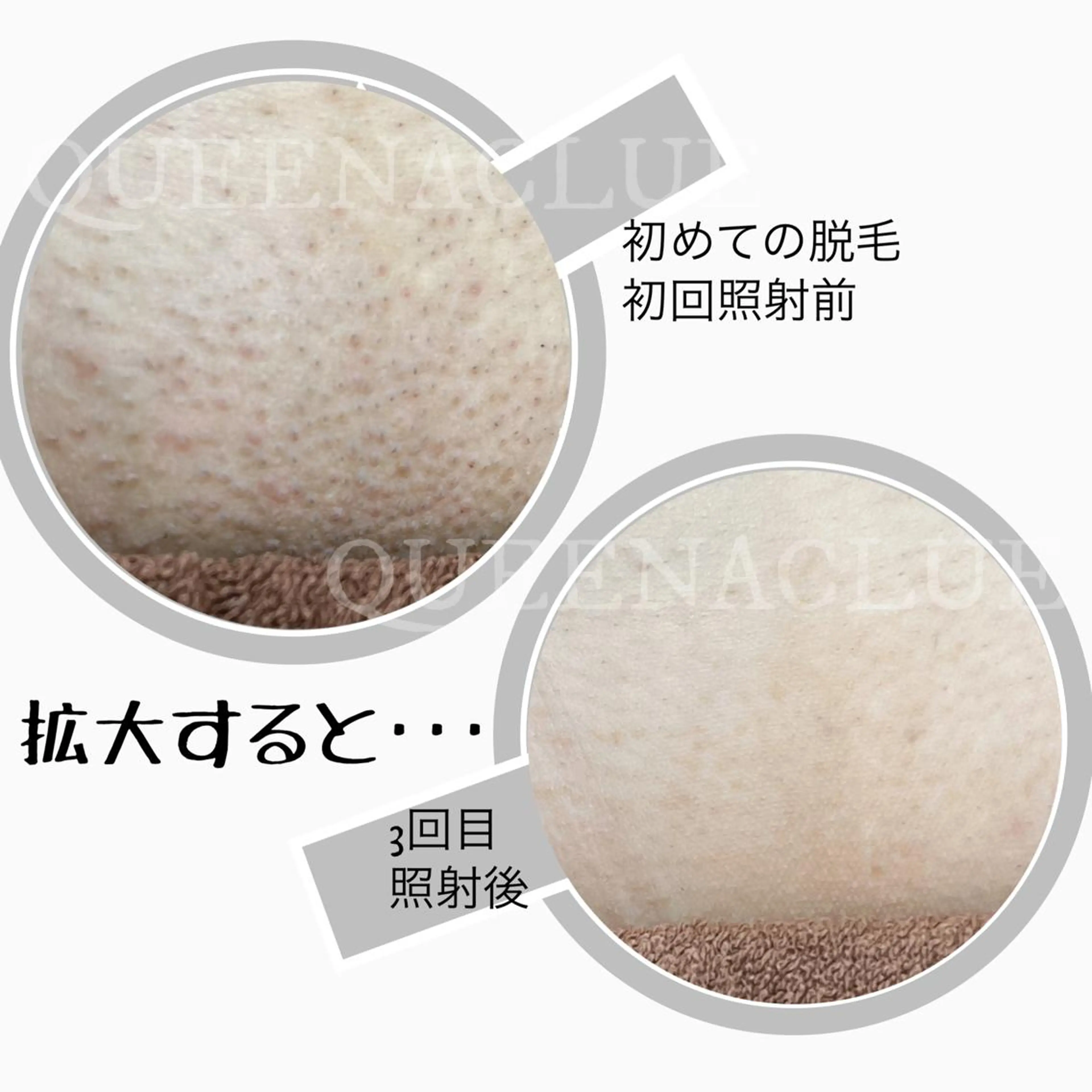 【 VIO 通い放題】 介護脱毛にも◎白髪になる前に！！【びっくりする程痛みが少なく美肌に脱毛】の写真