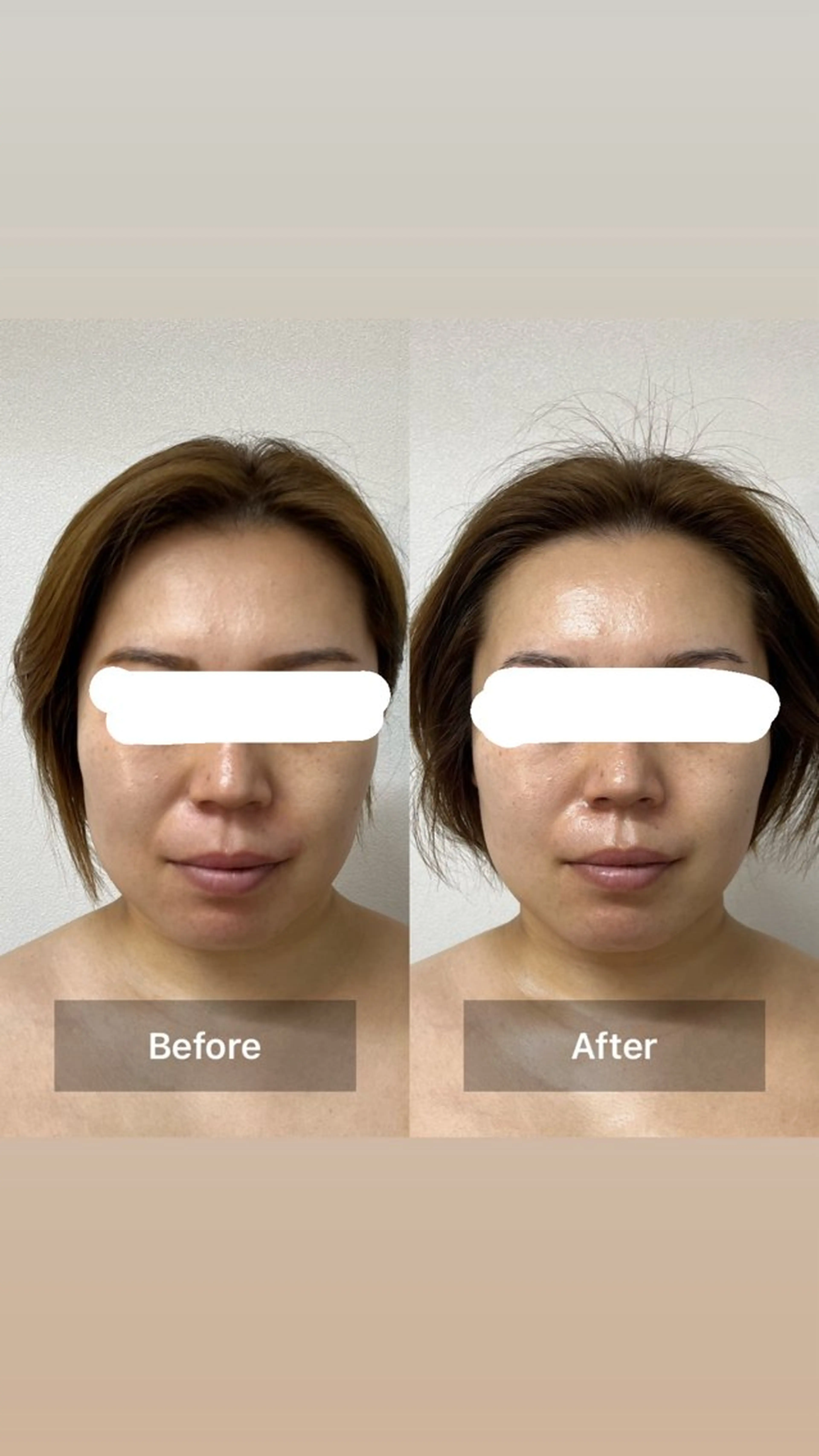 【先着2名様】速攻小顔リフクール＋美肌パック付き✨モニター価格19,800円→8800円の写真