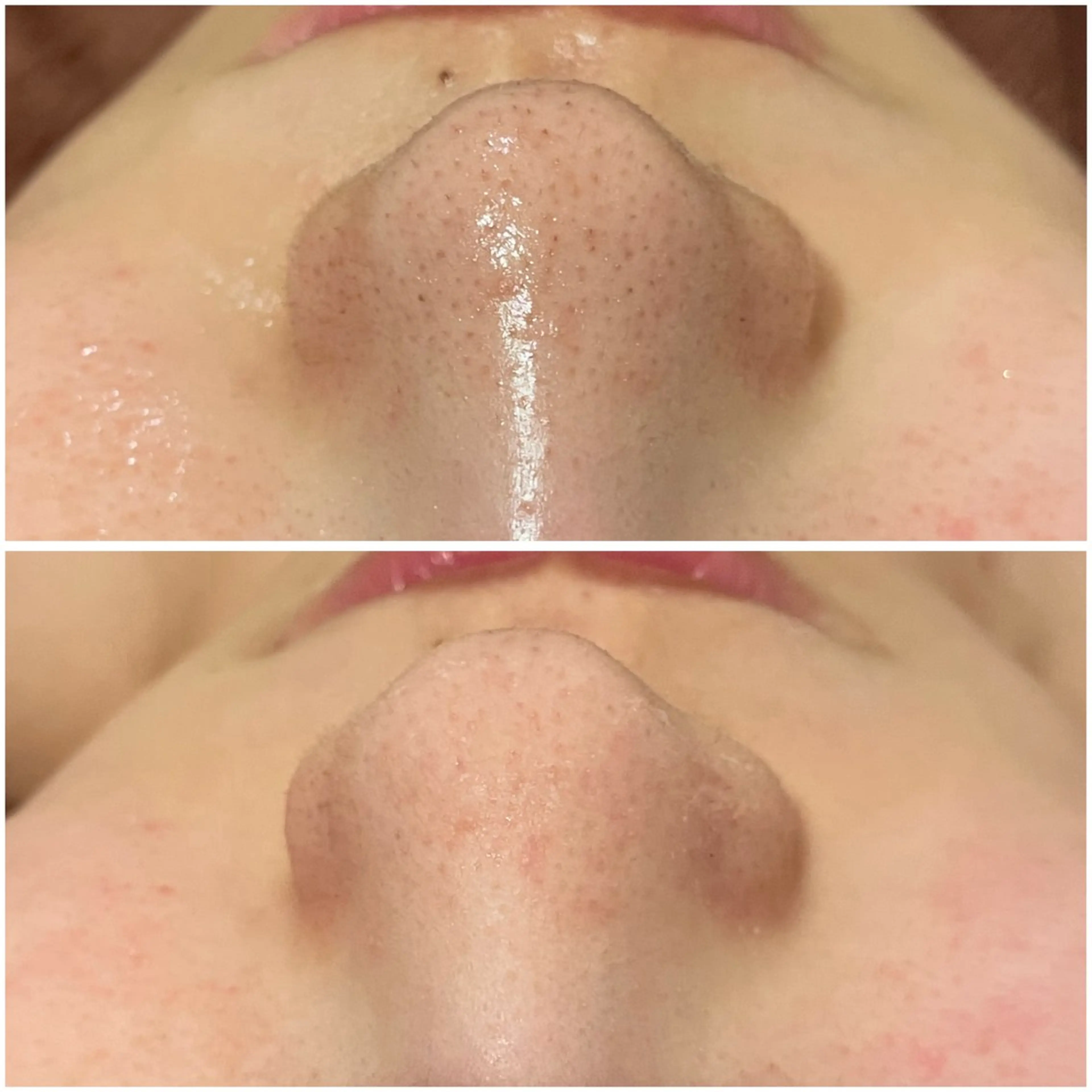 ニキビ特化型エステ 🍓最短で肌質改善のその他イメージ