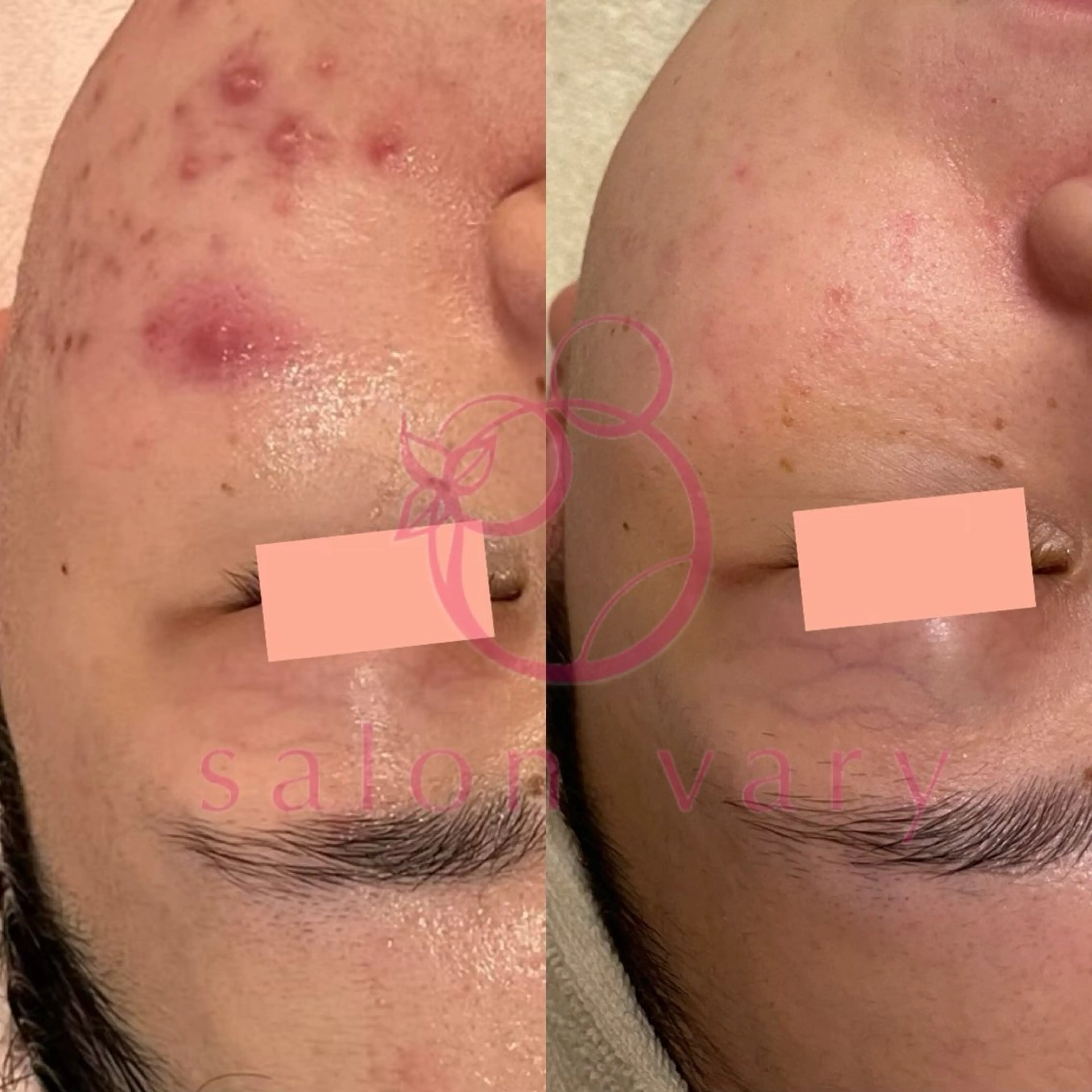 【ニキビ/肌管理】 salon varyのエステ・リラクイメージ