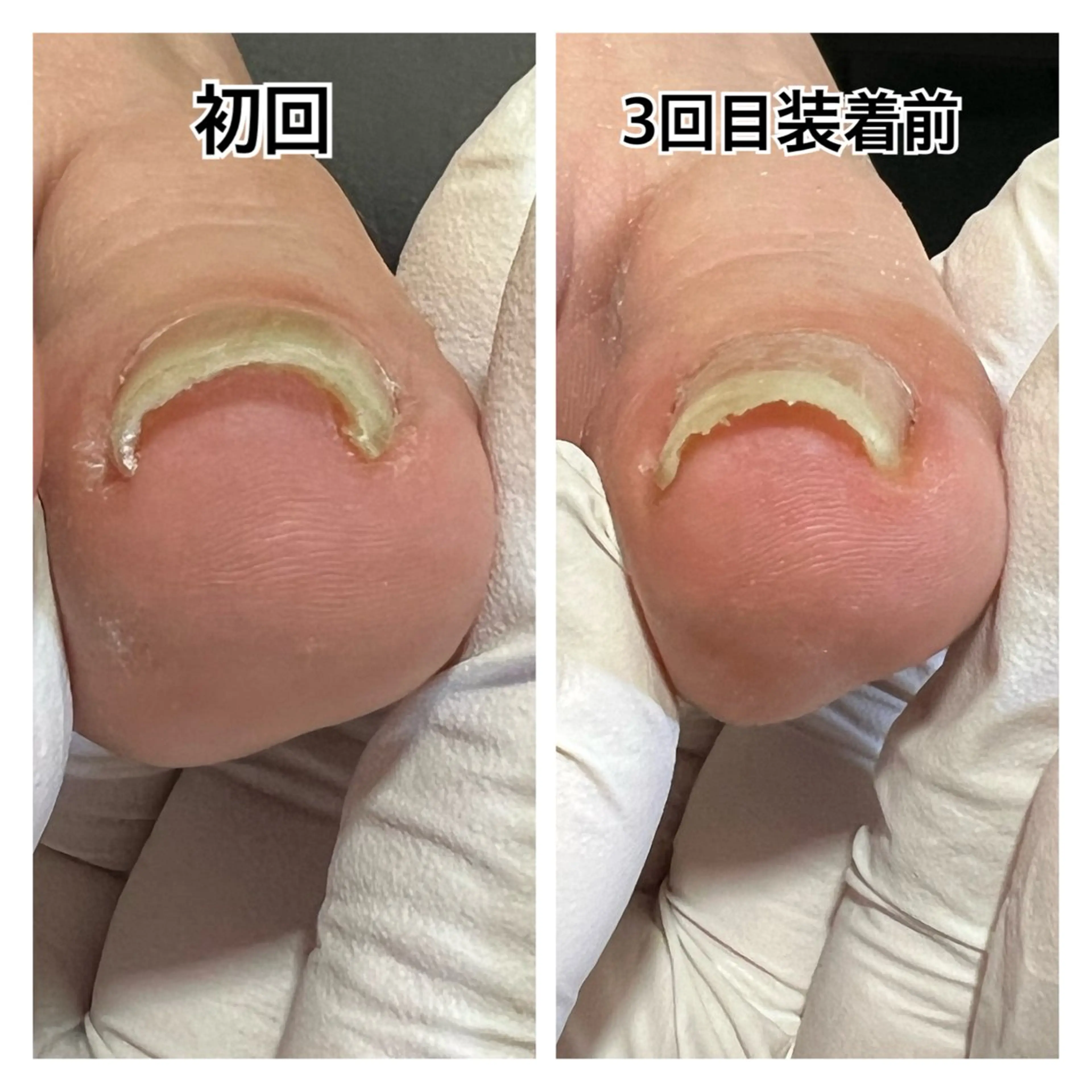 ⭐️ご新規様限定⭐️　　　　　　　　　　　　　　　　　　　巻き爪【重度】¥7,700※初診料別途の写真