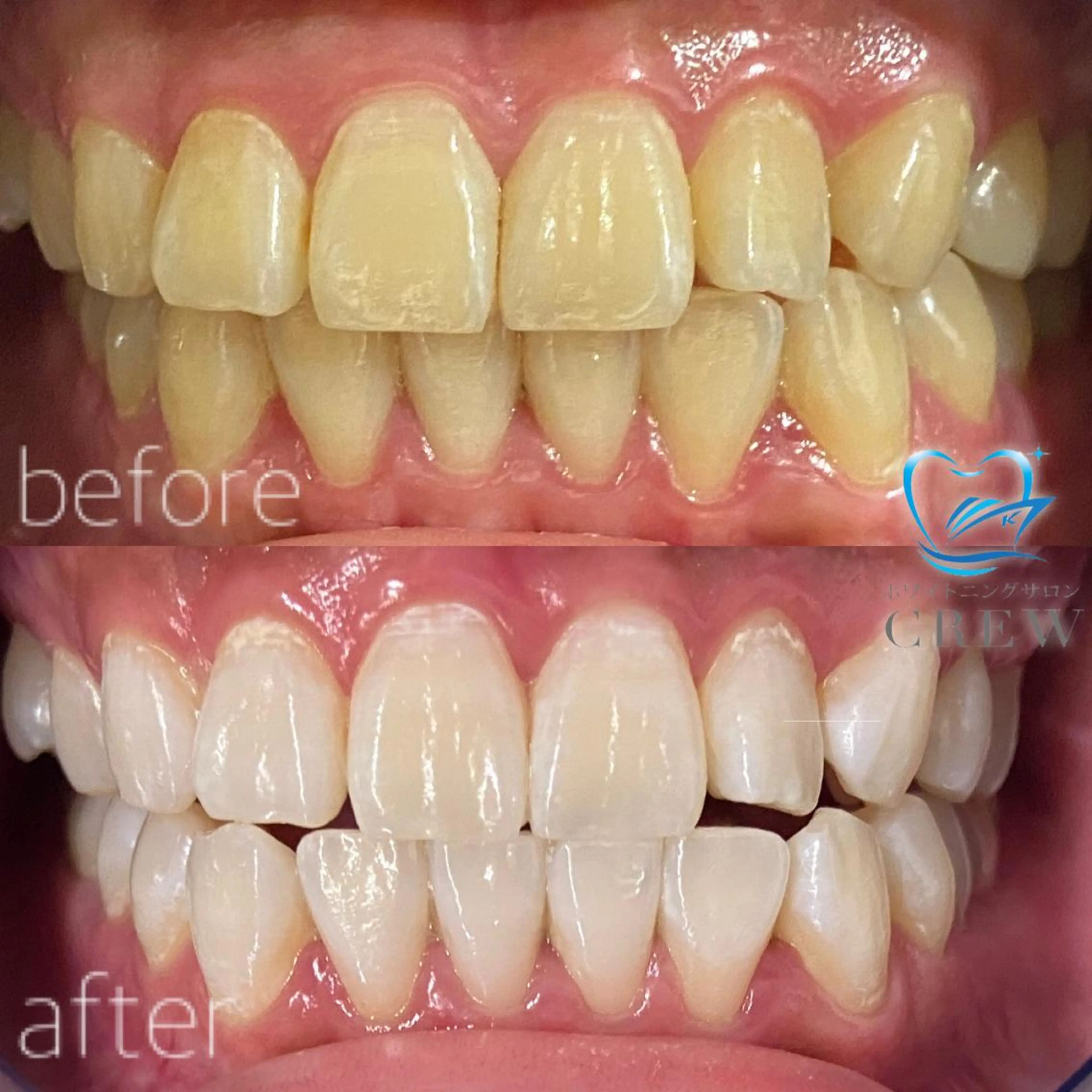 💠通常コース💠 15分×3照射 ¥9,500円🦷✨の写真