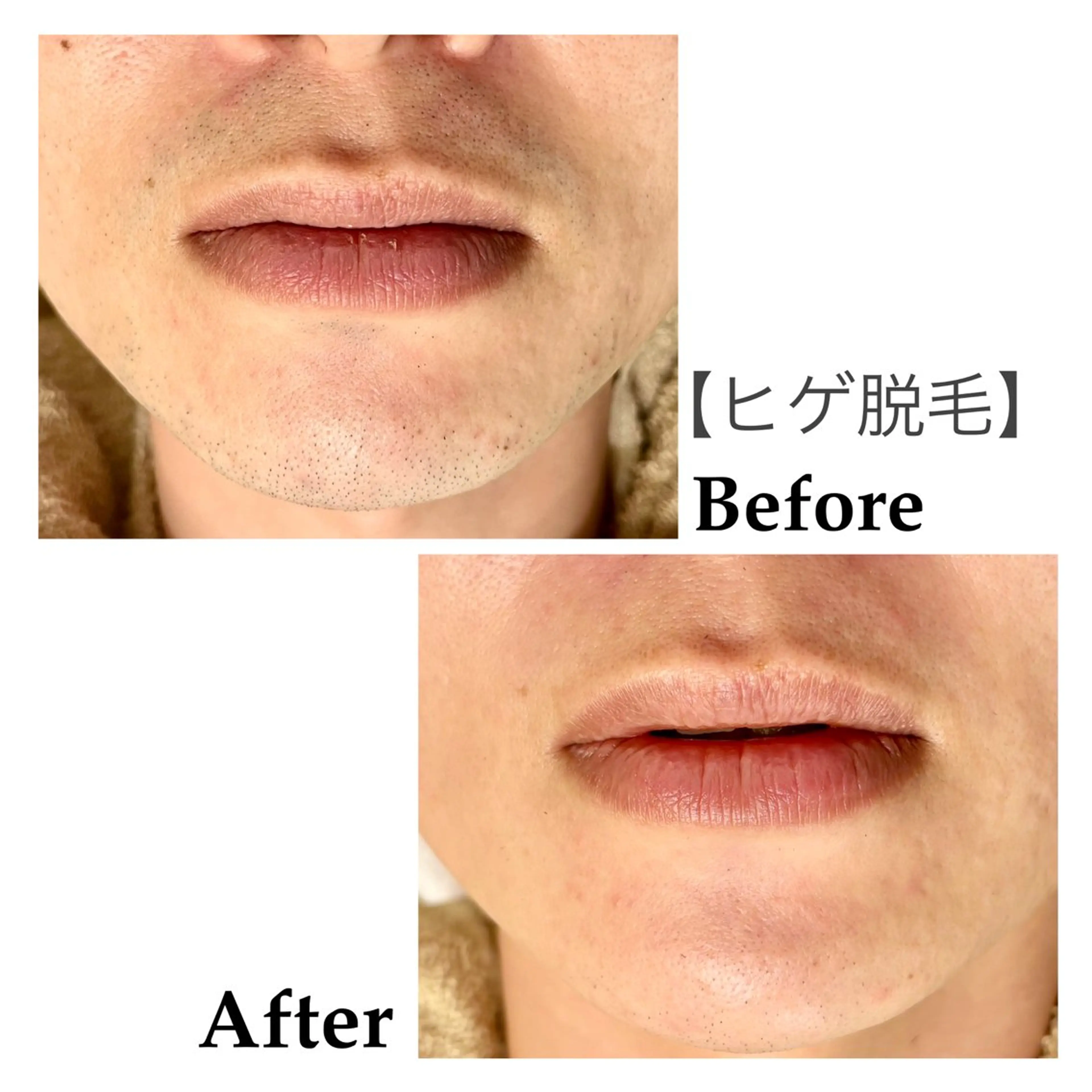 メンズ 脱毛 脱毛サロンFIS【新宿店】所属・堺 祐季奈のエステ・リラクイメージ