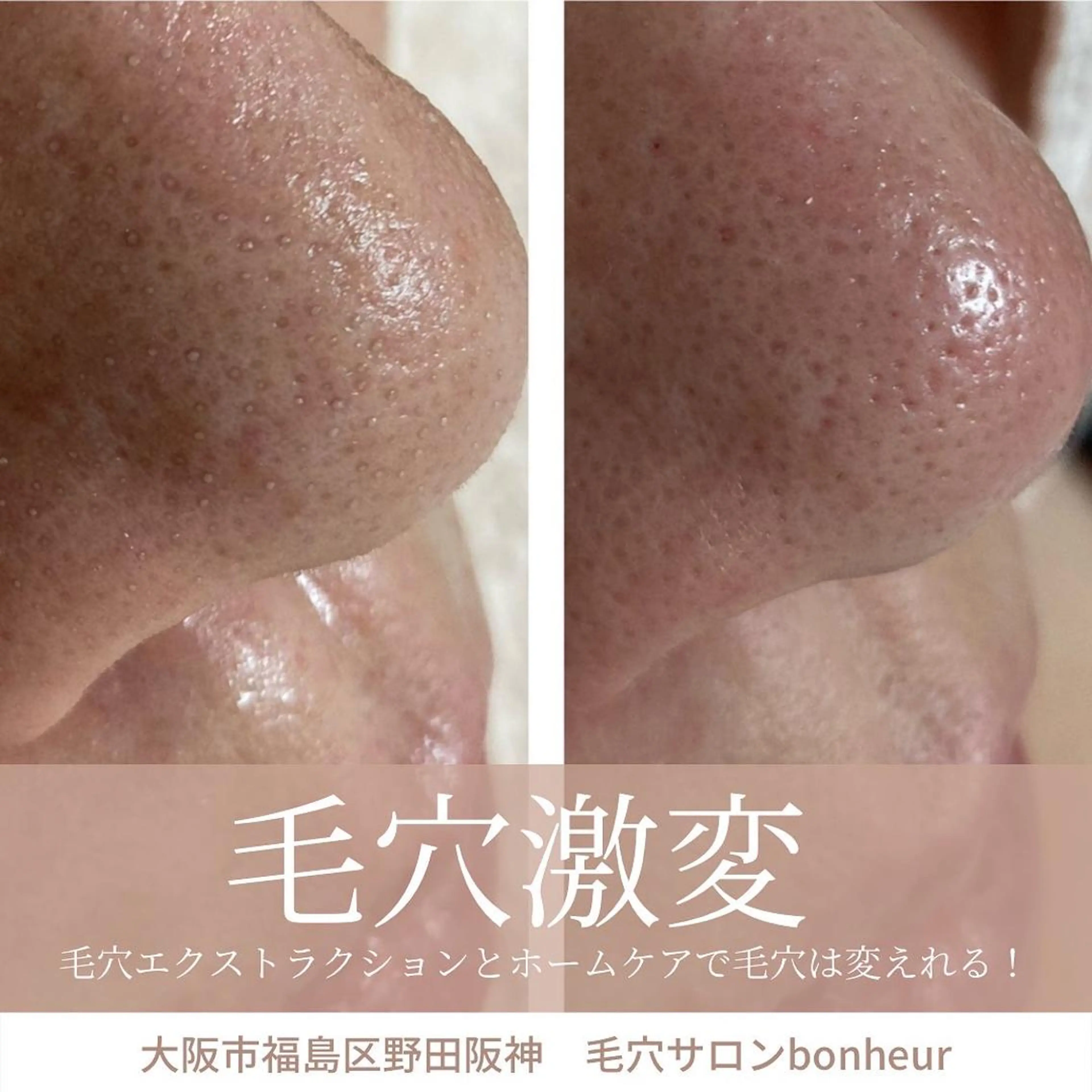 エステ 毛穴ケア・肌質改善 徳川のエステ・リラクイメージ