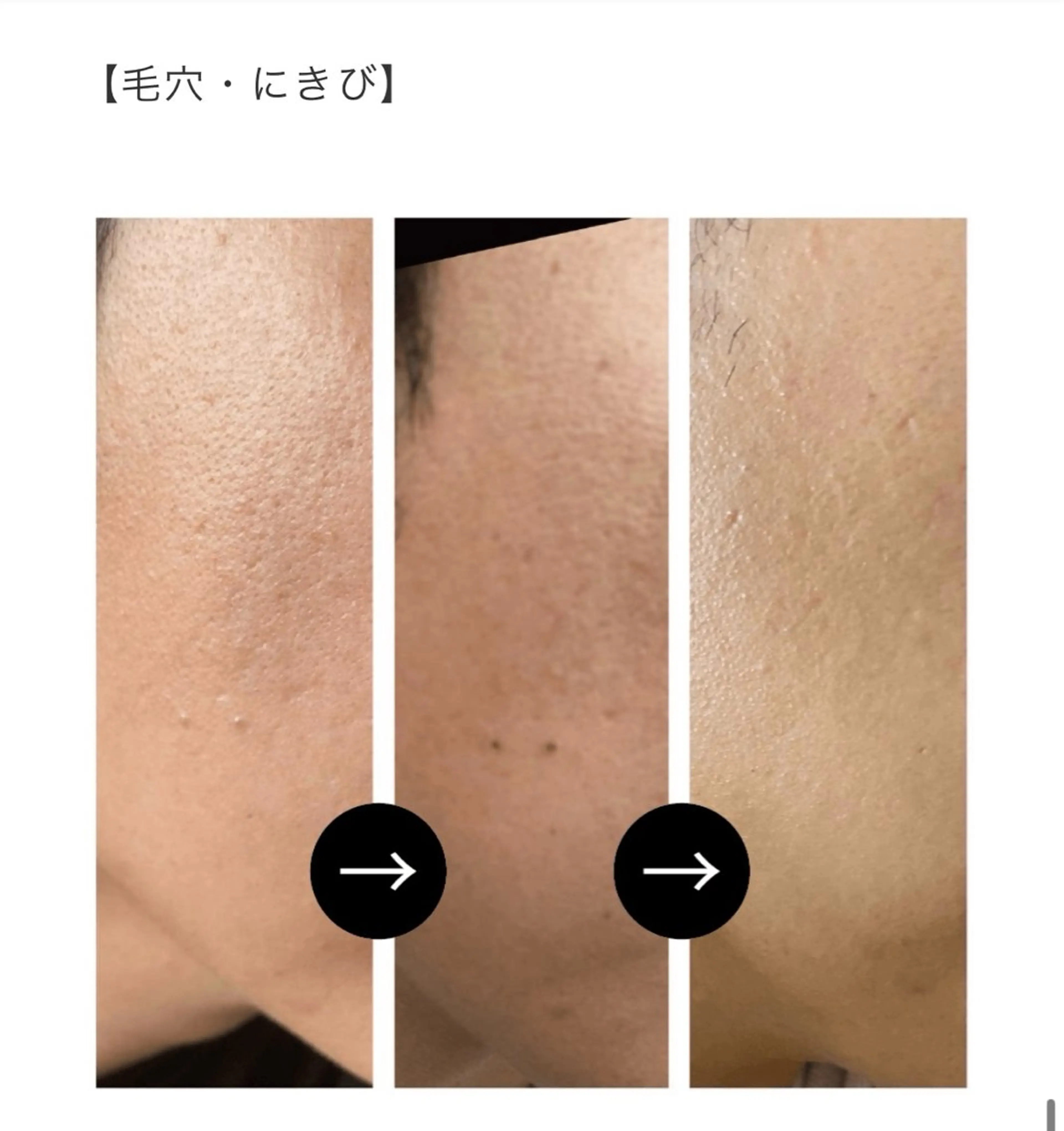 プラズマシャワー (お悩み別美容液導入付き)の写真