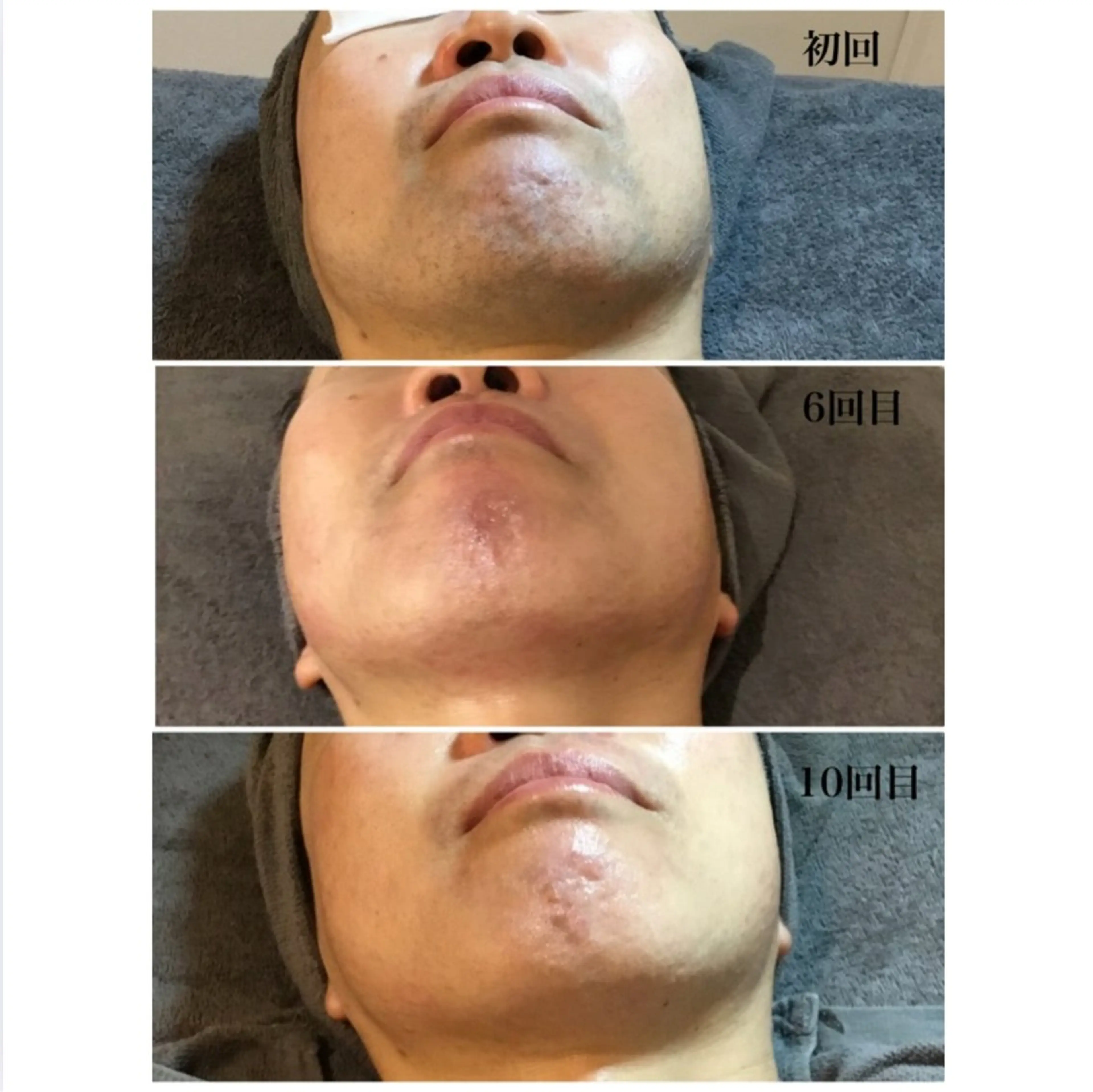 肌質改善エステ付き、メンズひげ脱毛の写真