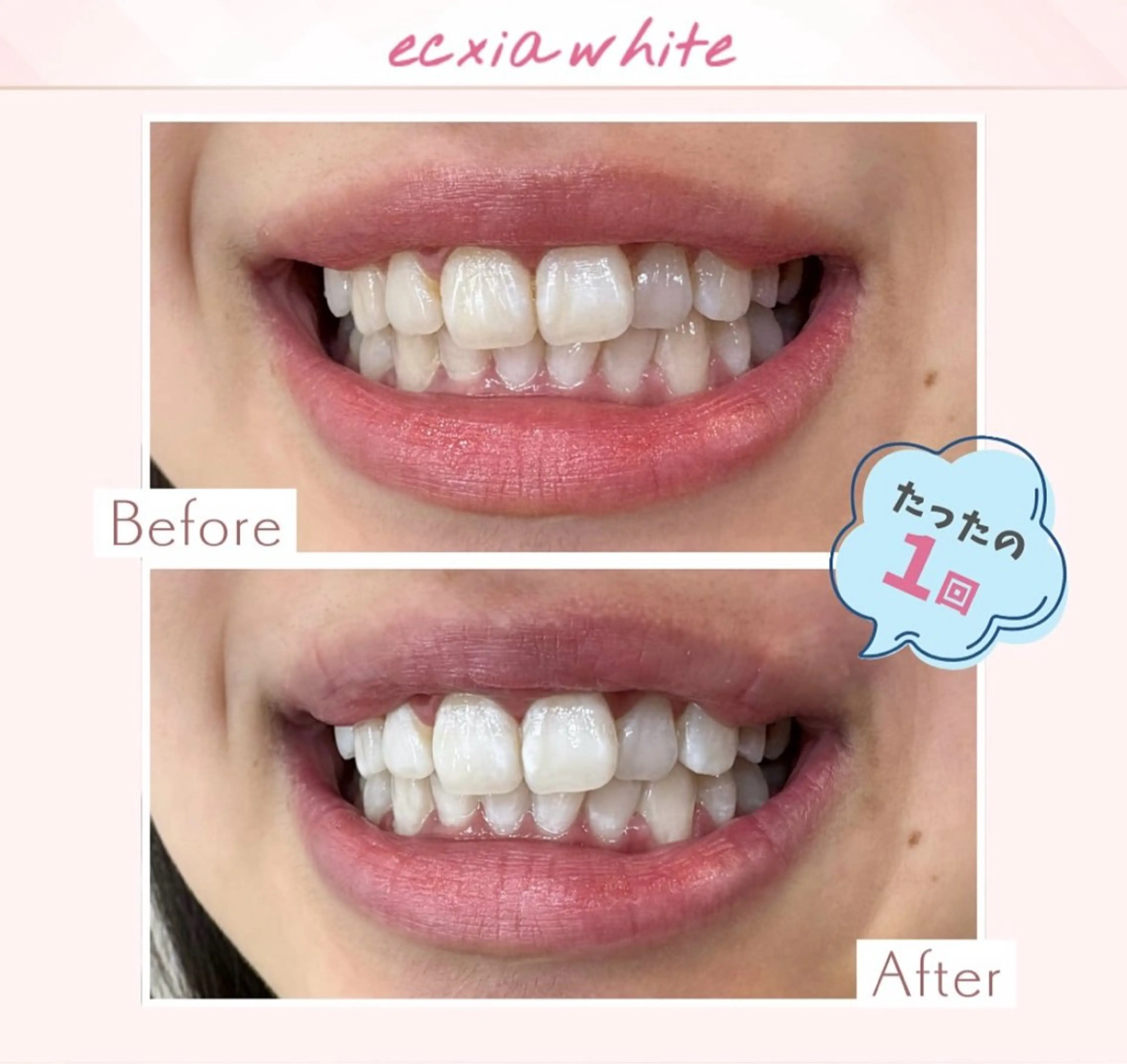 エクシアホワイト調布所属・umi❤︎ ホワイトニングのその他イメージ