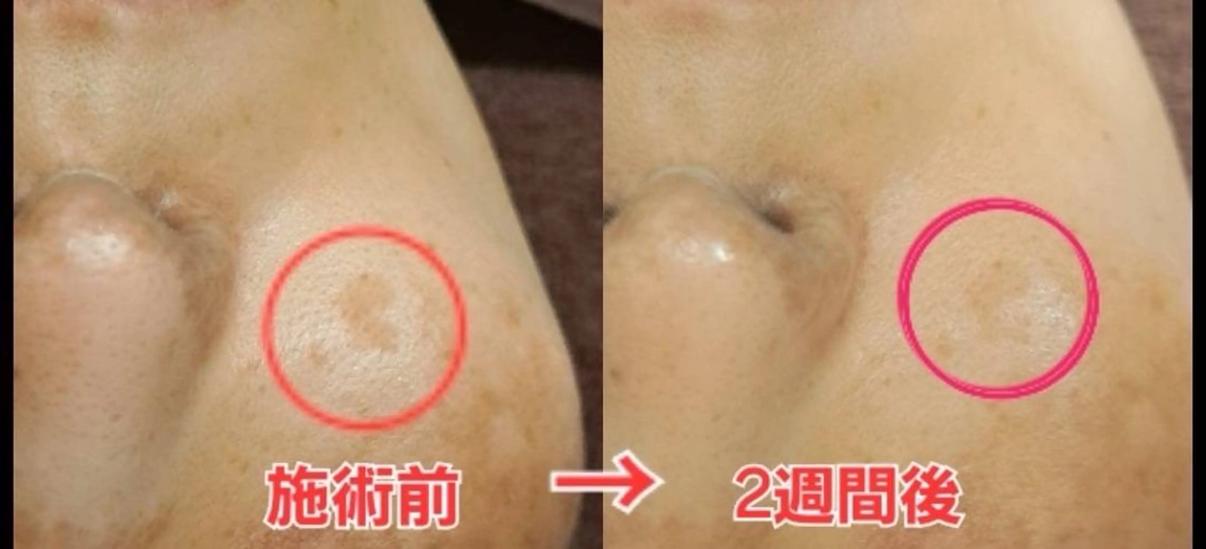 しみケアデトックス30分の写真