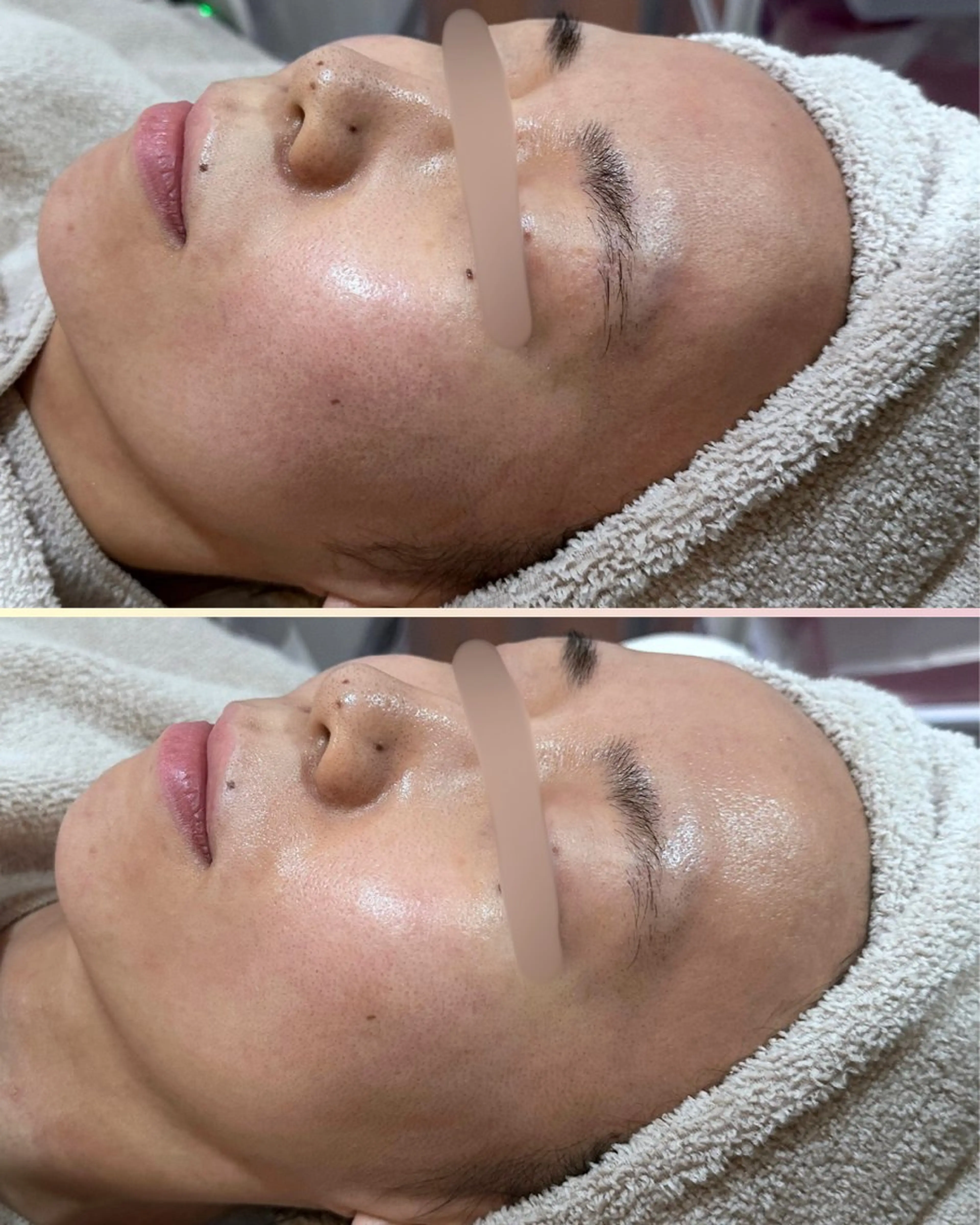 エステ |ピーリング・毛穴| soina神楽坂のエステ・リラクイメージ