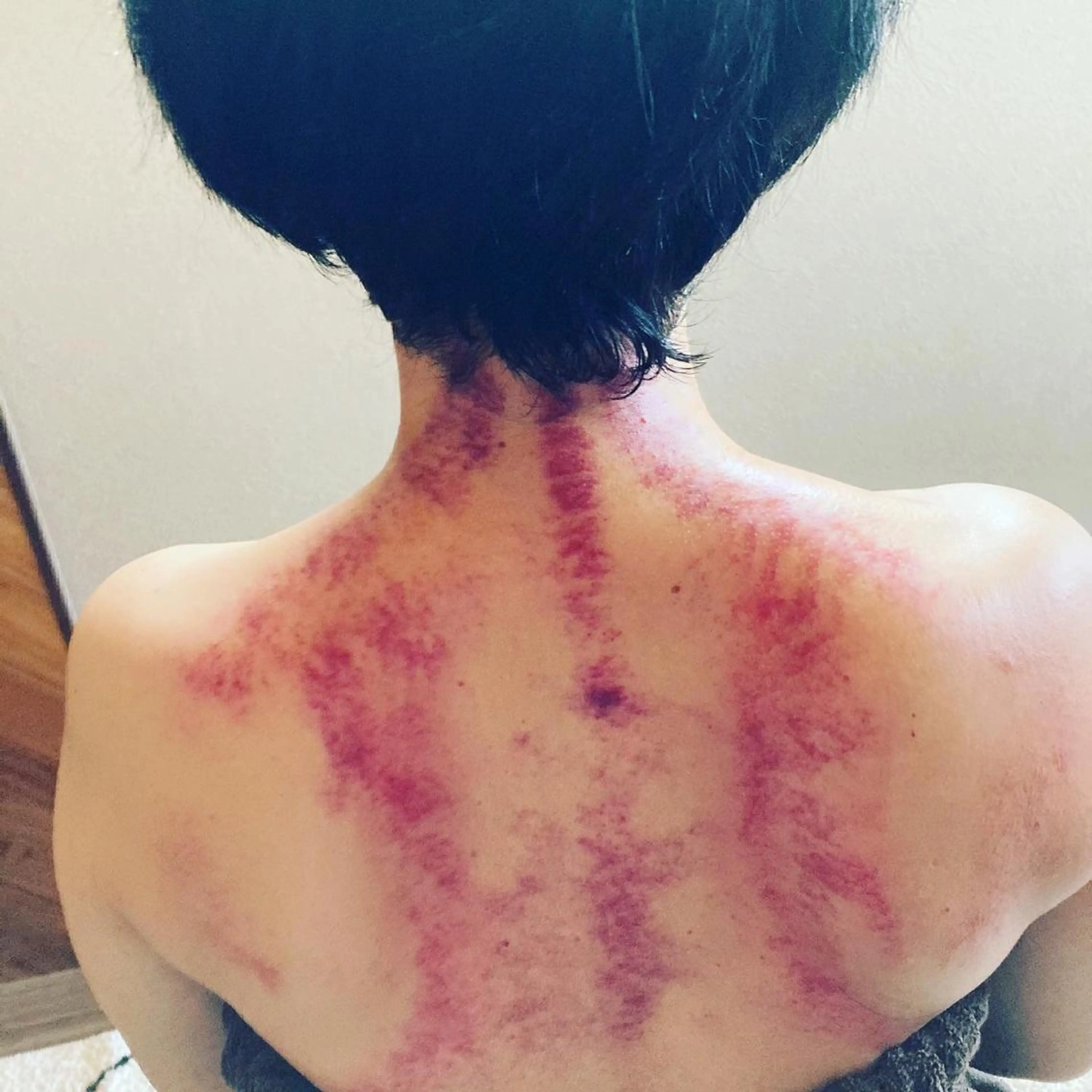 毒素が溜まっている貴方へ✩かっさ！頭～上半腰まで毒素をながそう✩.*˚の写真