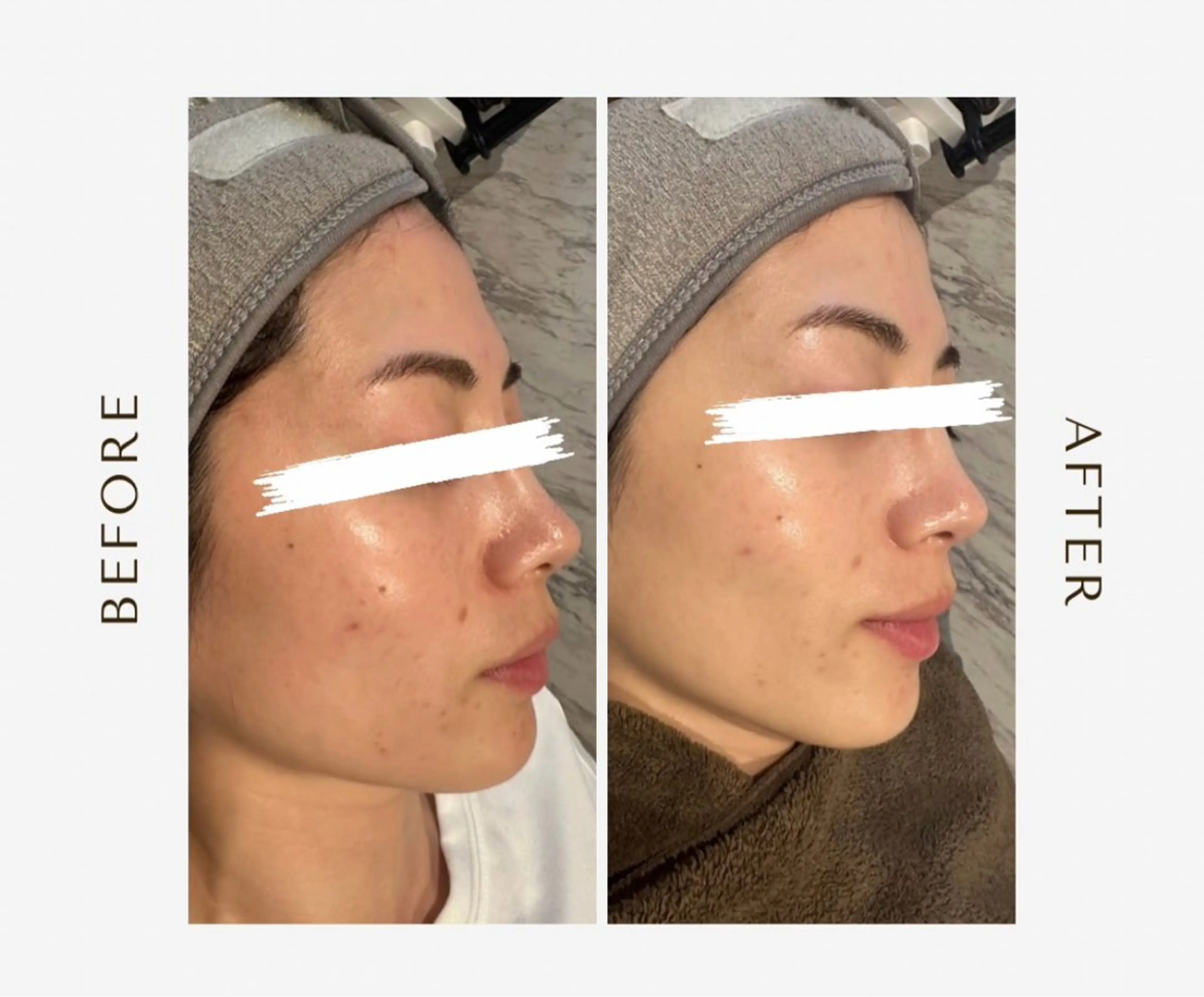 ハーブピーリング（当日お化粧OK）の写真