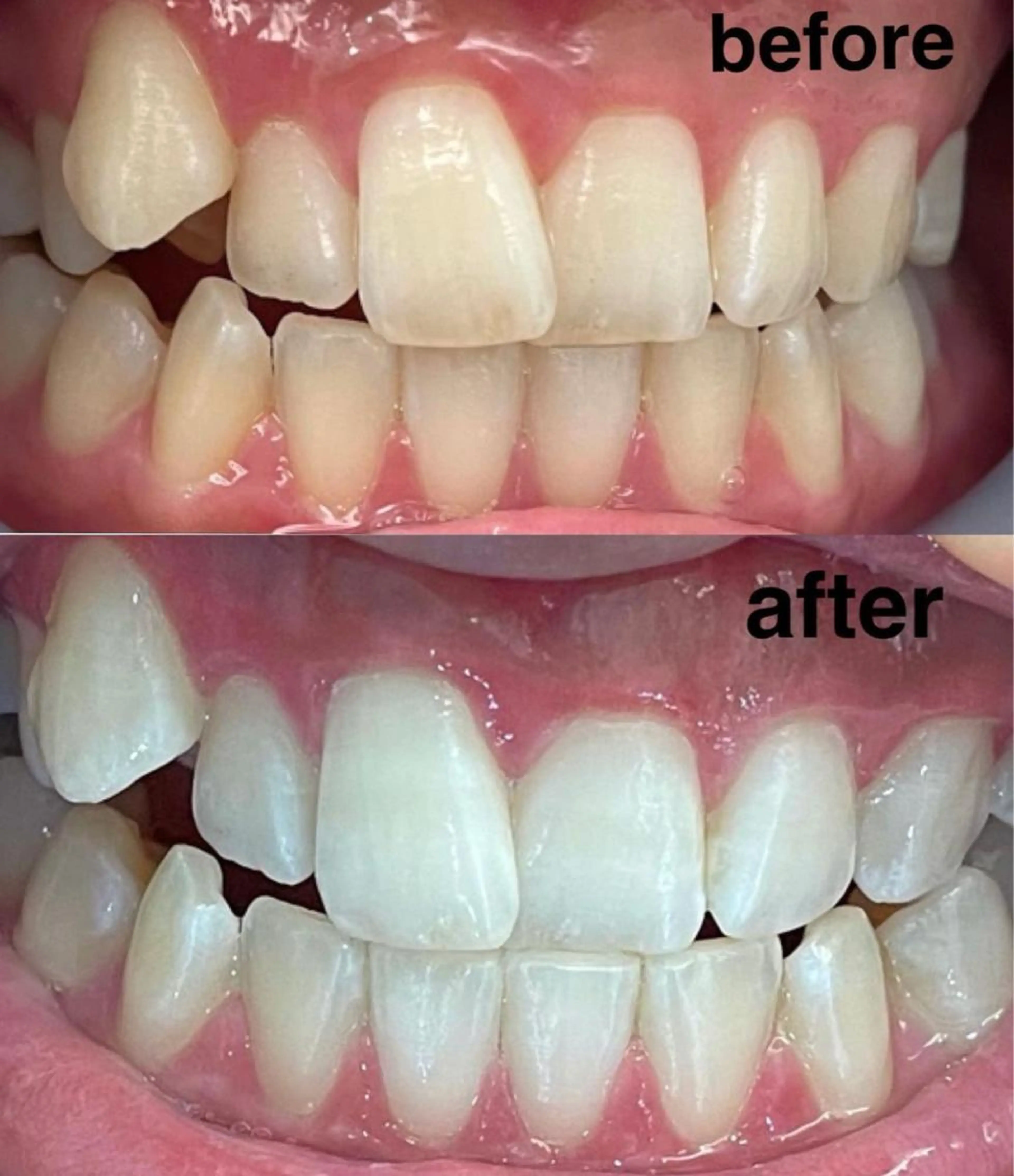 ホームホワイトニング来店付セットの写真