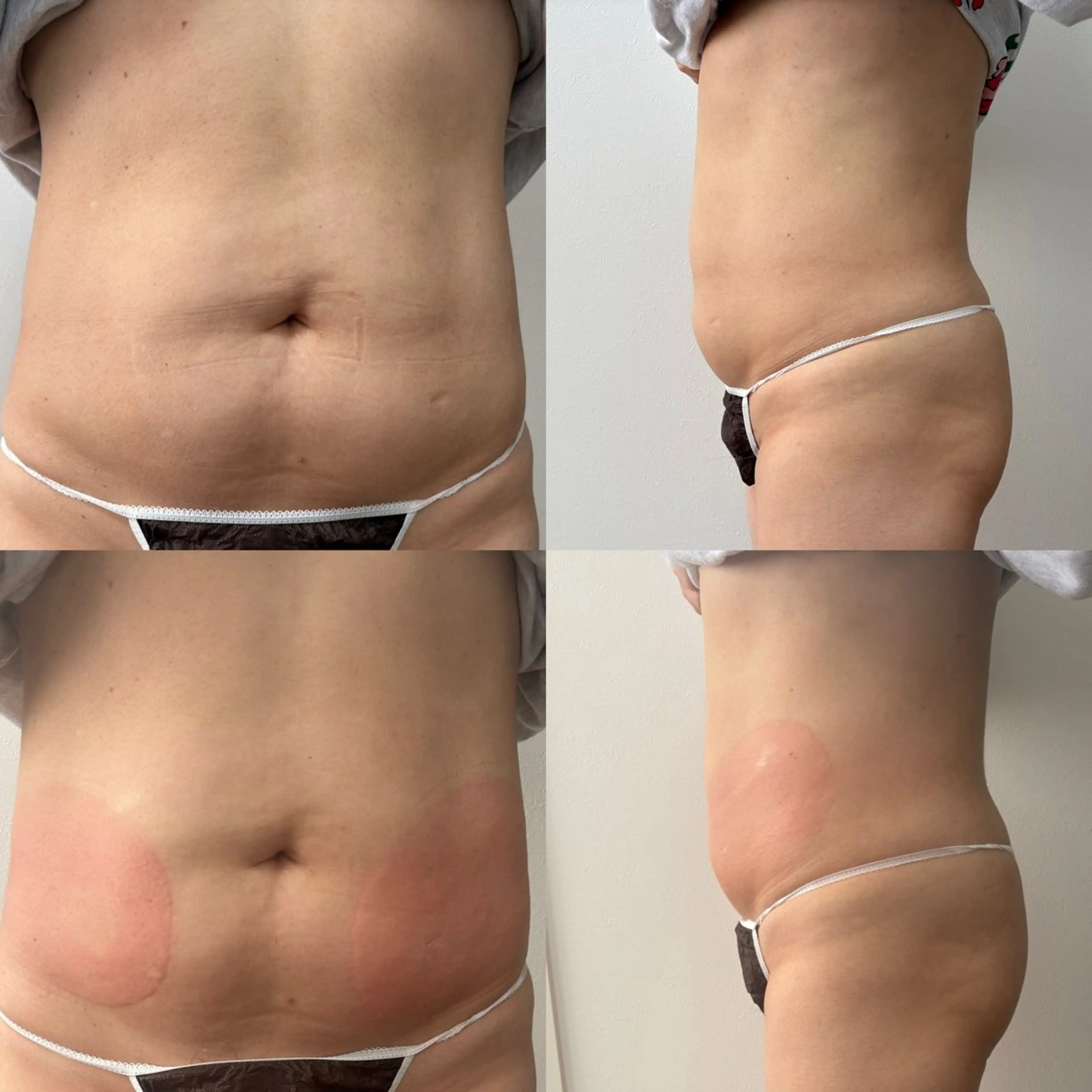 Miiju.所属・Miiju. 石巻市 脂肪冷却  鈴木のエステ・リラクイメージ