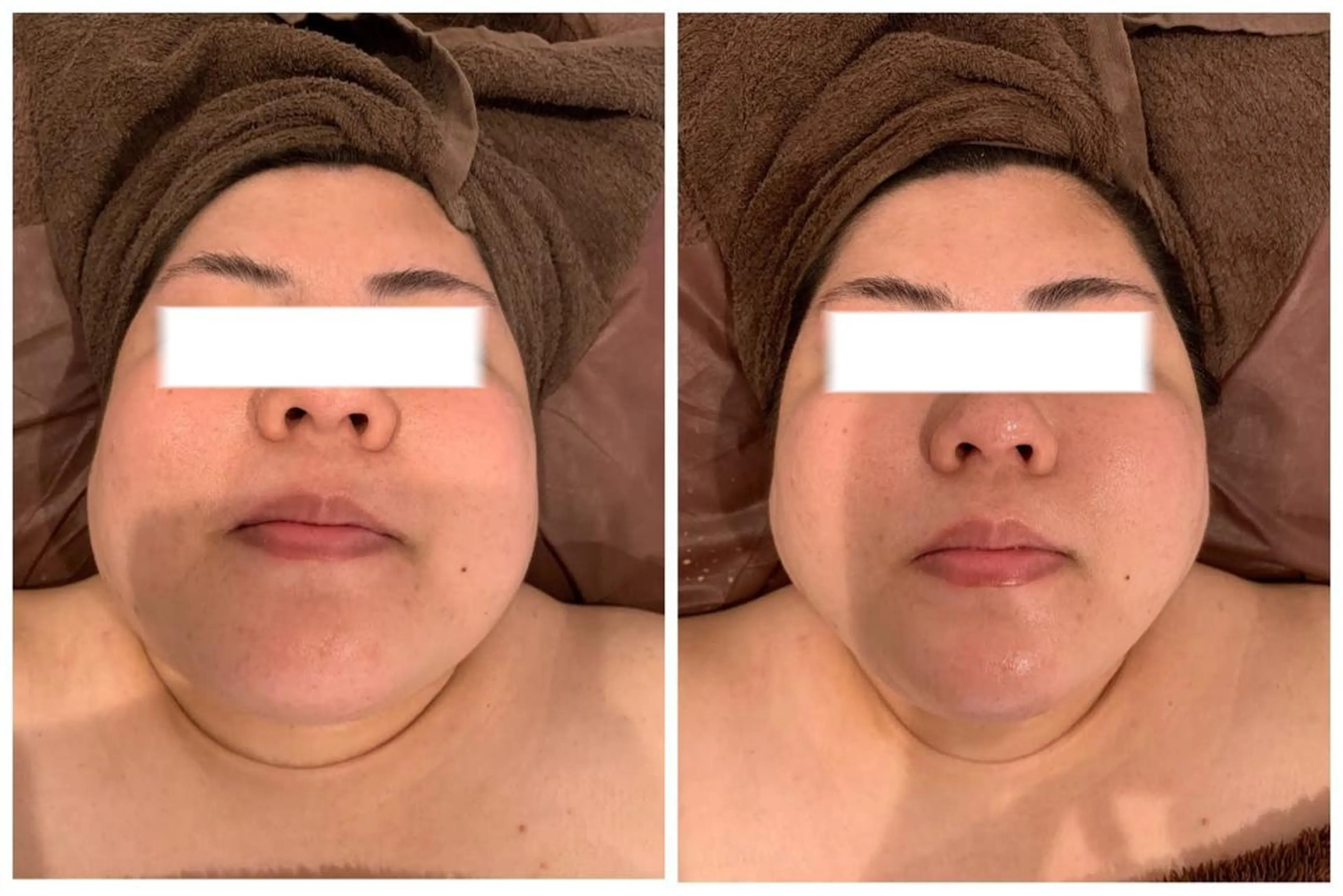 エステ Chalon所属・REVI取扱・肌悩み 毛穴Chalonのエステ・リラクイメージ