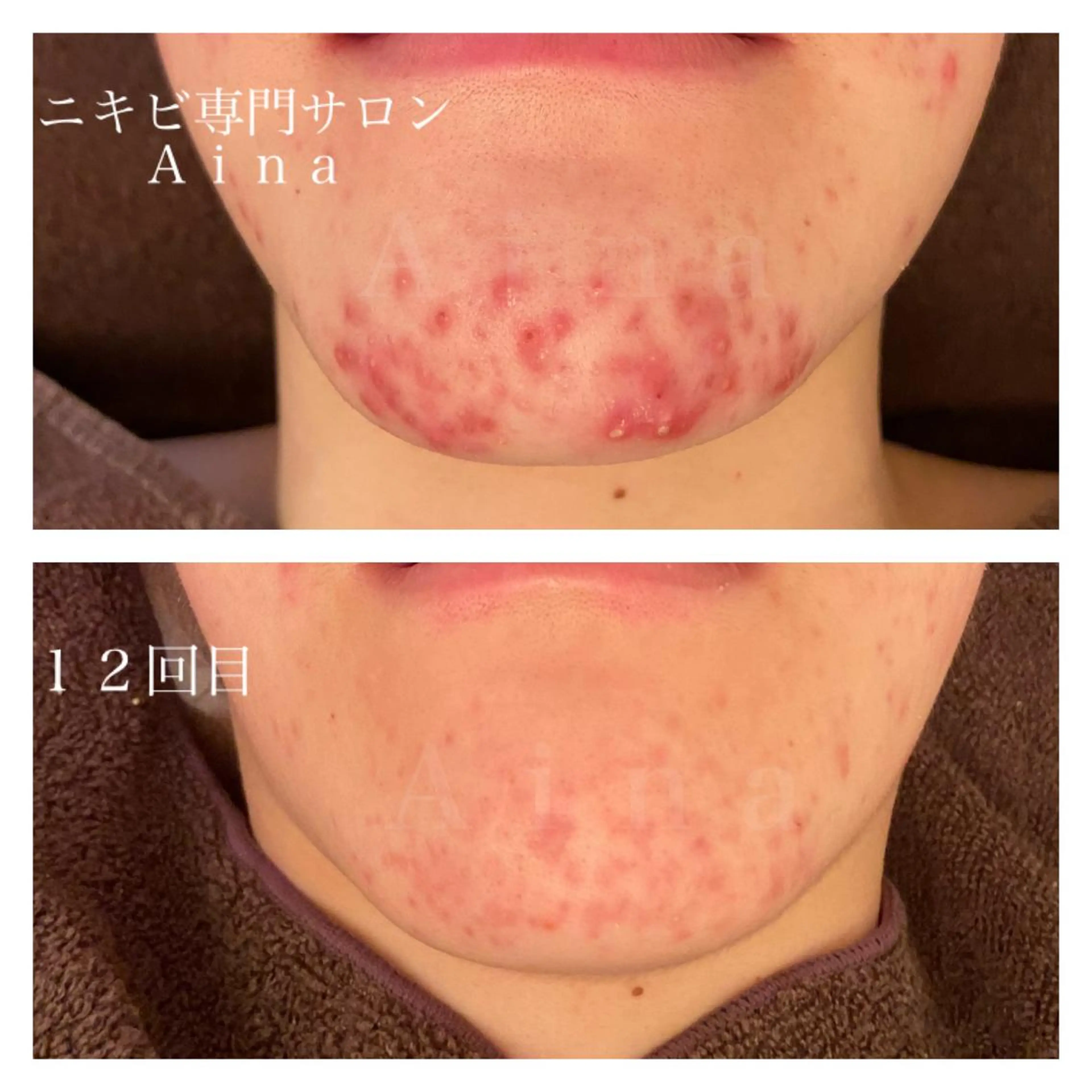 ロング カラー パーマ ヘアアレンジ メンズ キッズ ネイル マツエク・マツパ 赤色 エステ リラク ニキビ跡専門サロン Ａｉｎａのエステ・リラクイメージ