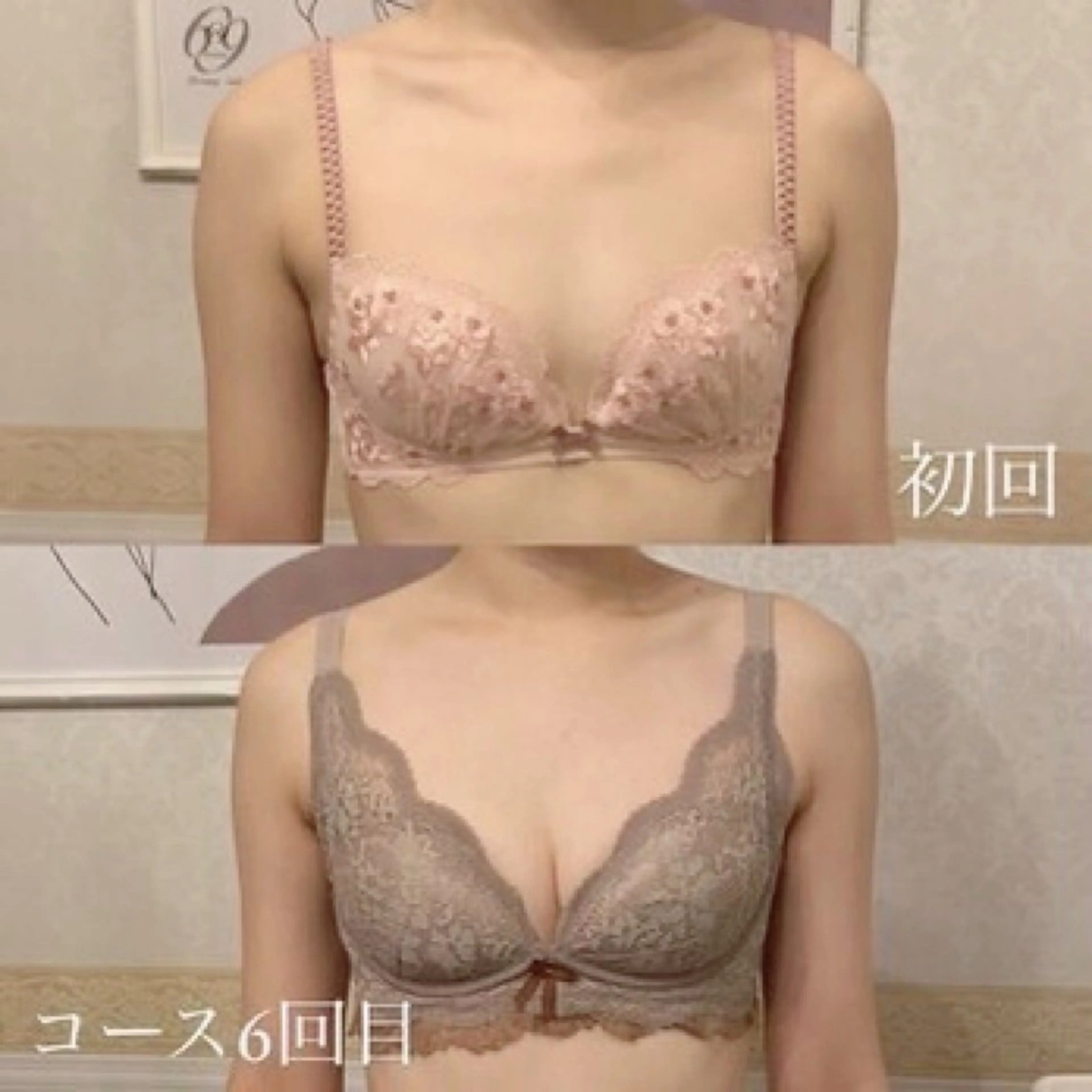 【デコルテの隙間・下垂・産後授乳後のお悩み改善】バストケアの写真