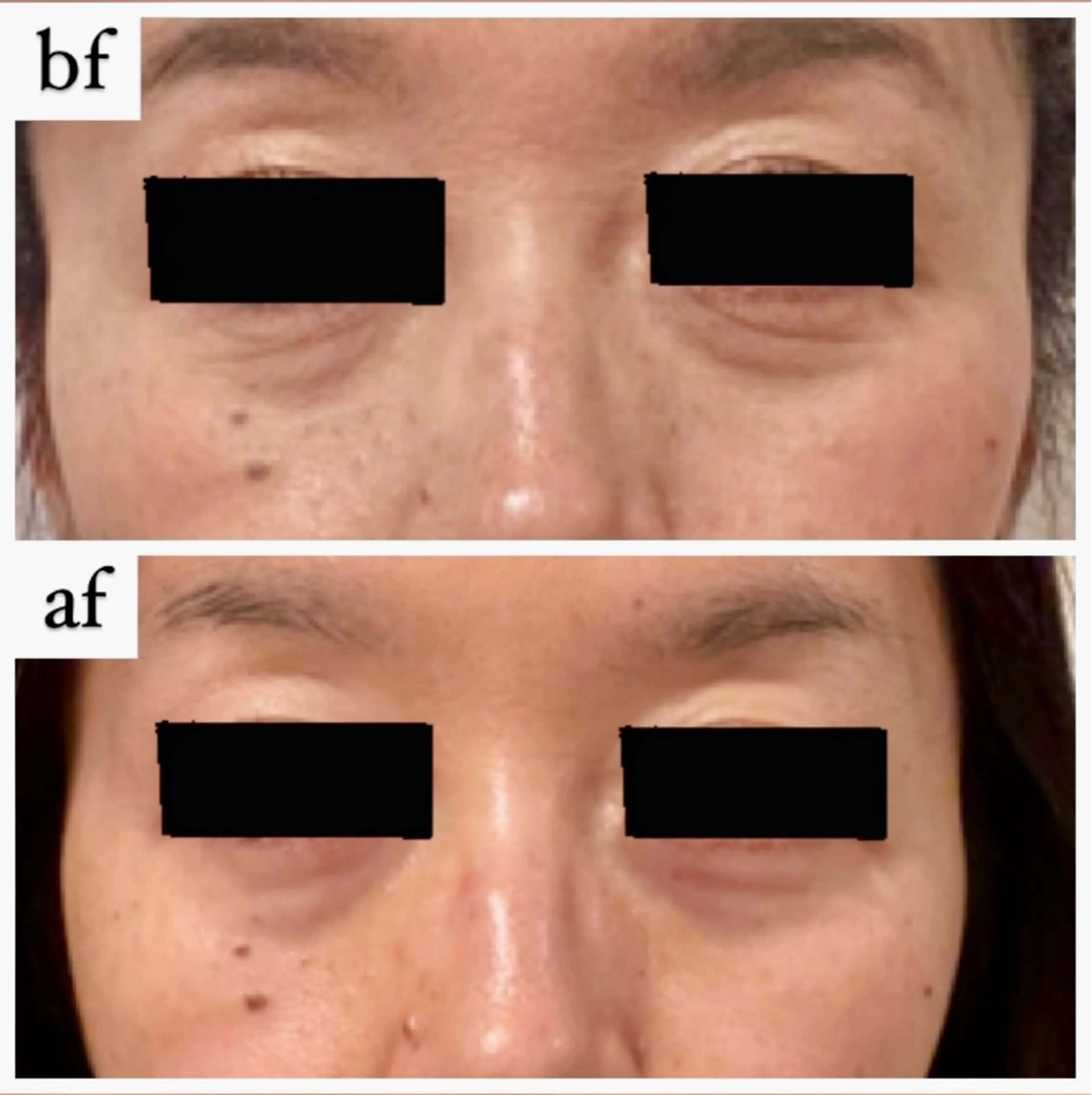 エステ 【ハーブピーリング】 Allumentのエステ・リラクイメージ