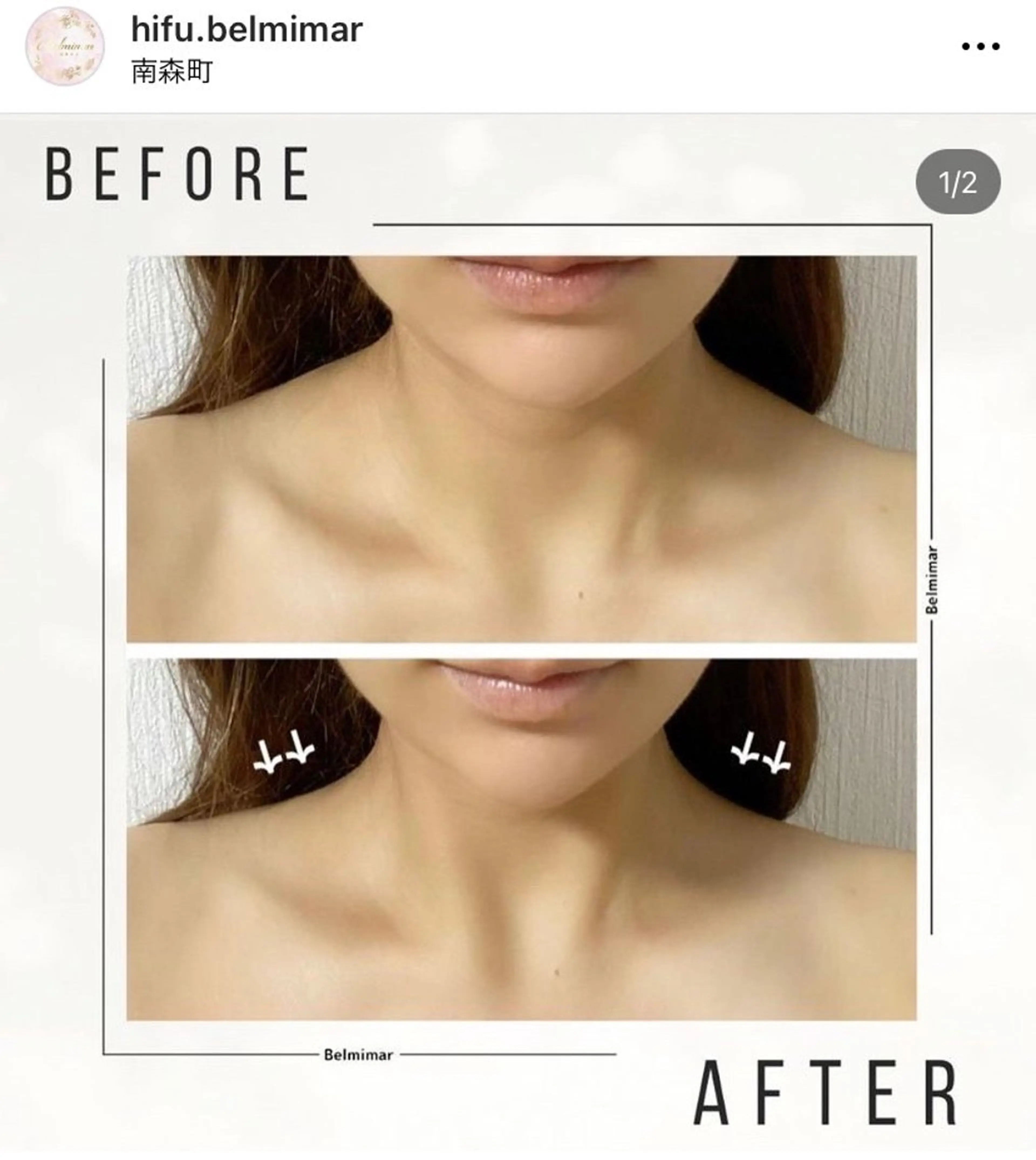 首＋肩スッキリ◎¥8,800→¥7,000今だけミニモ価格★国産の医師と共同開発した機械で首周りスッキリ小顔♪の写真