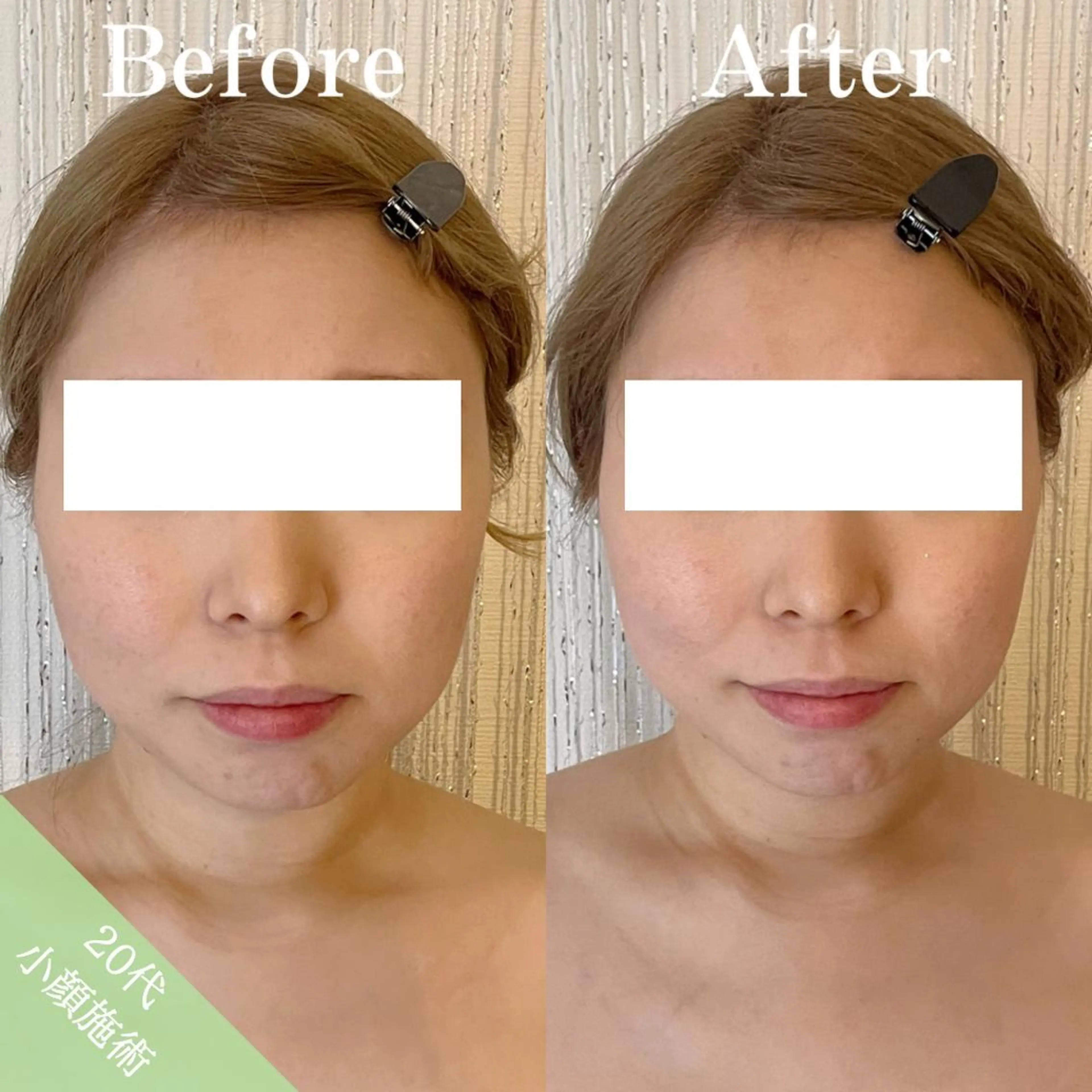 【エメラルドコース】最新マシンであの小顔体験をもう一度*50分施術の写真