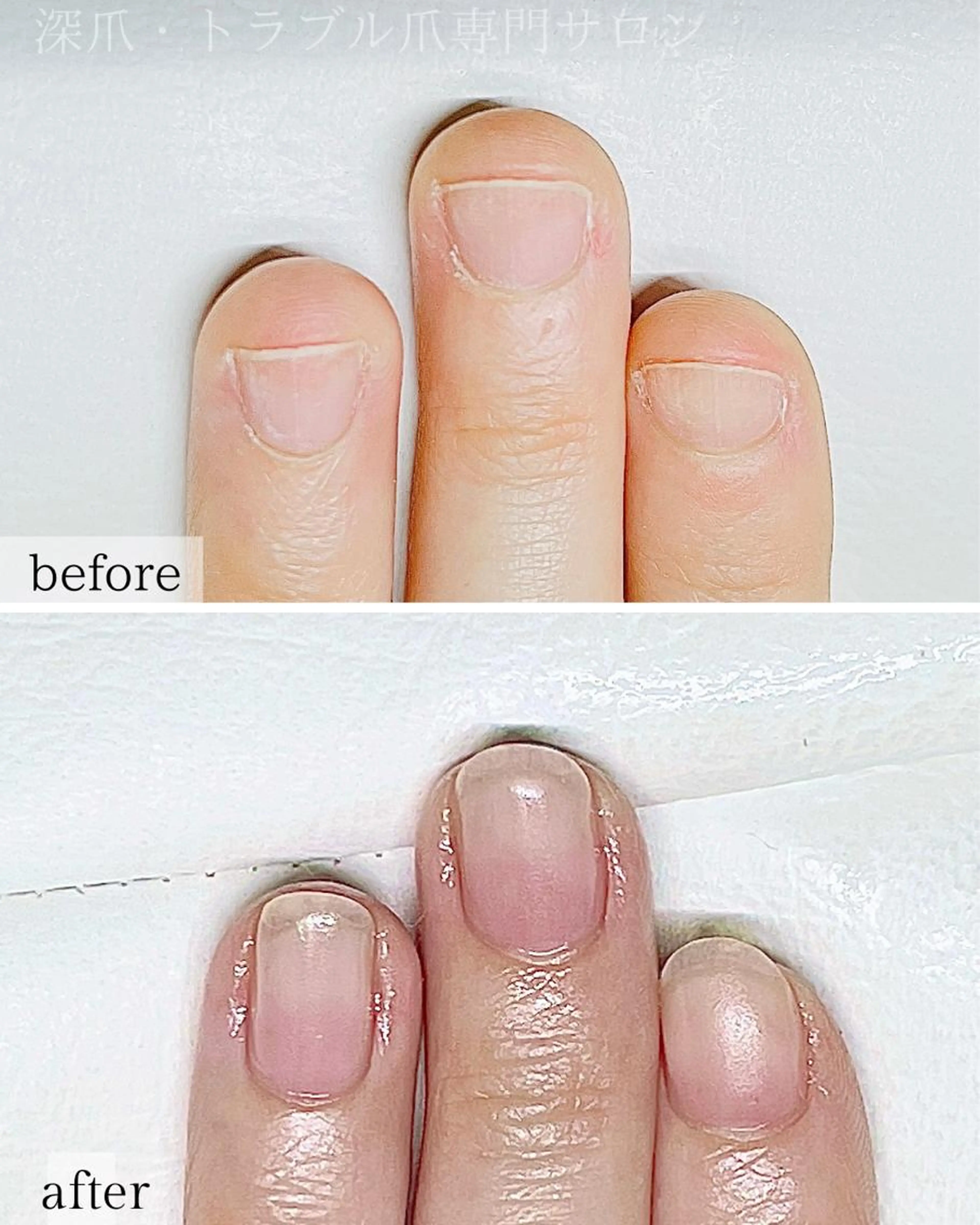 深爪ケアの写真