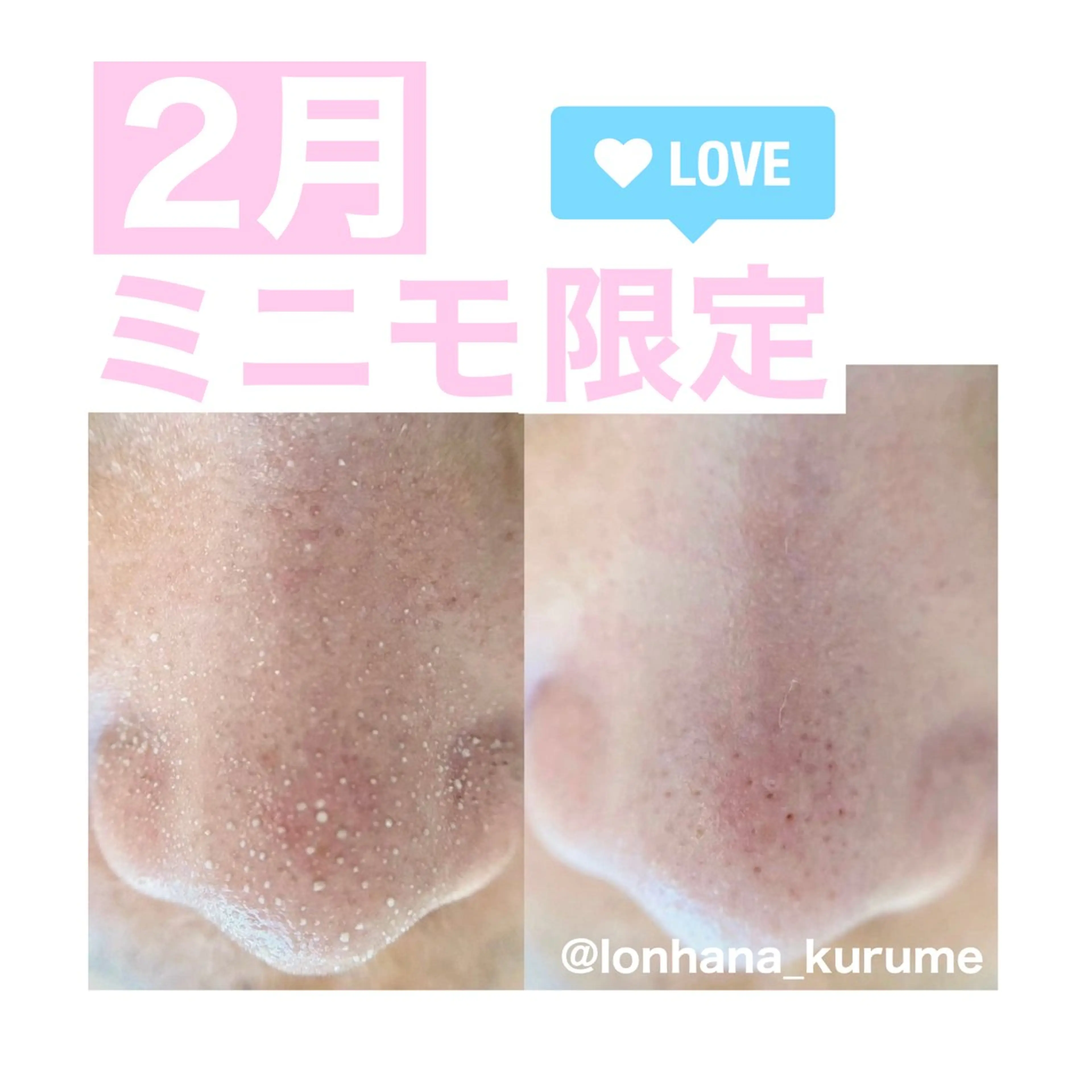 ホワイトニング|韓国式3D毛穴洗浄 lonhana ロンハナ所属・韓国式3D毛穴洗浄 lonhanaのその他イメージ