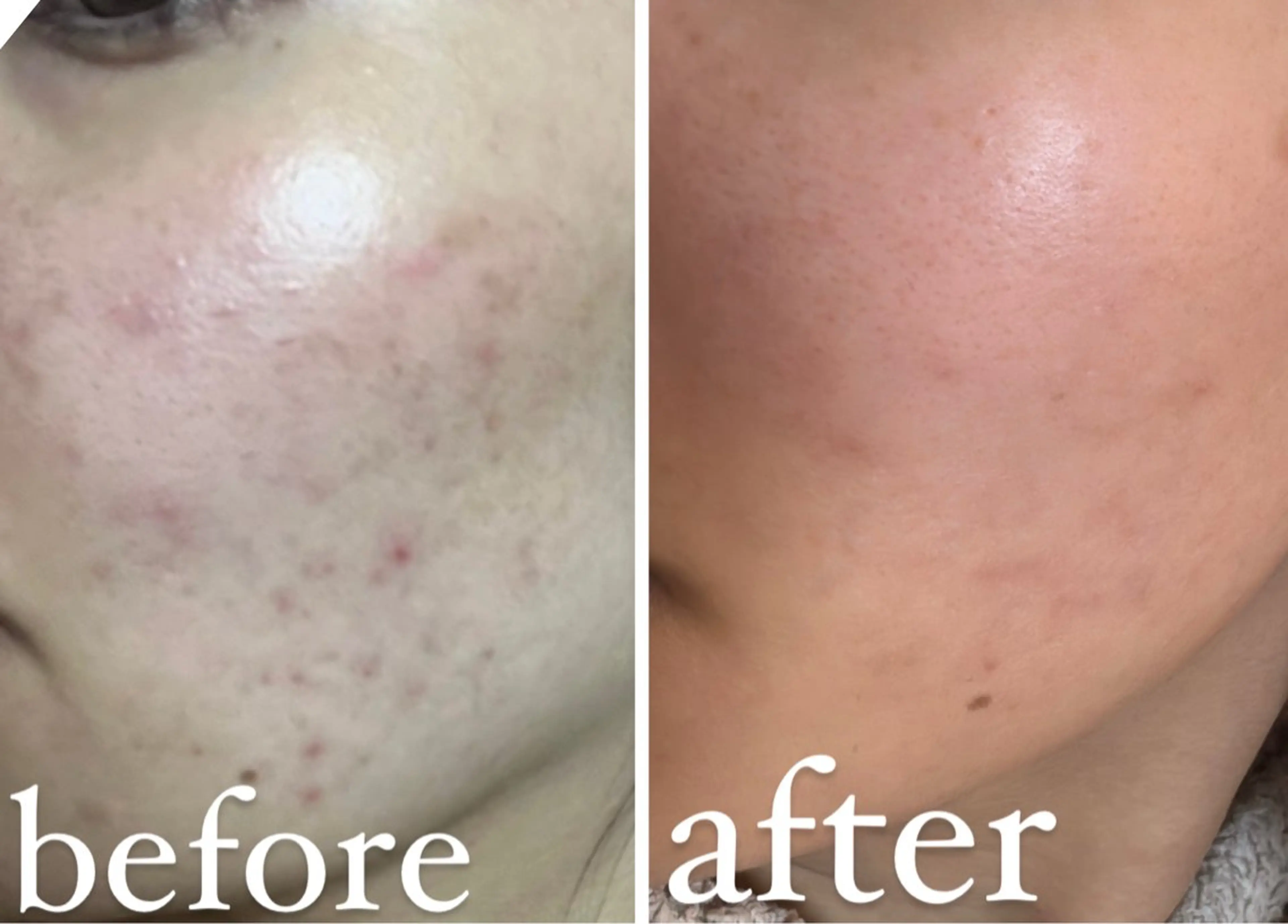 つるんとした手触りへ【毛穴洗浄&発酵セラミド/炭酸パック】の写真