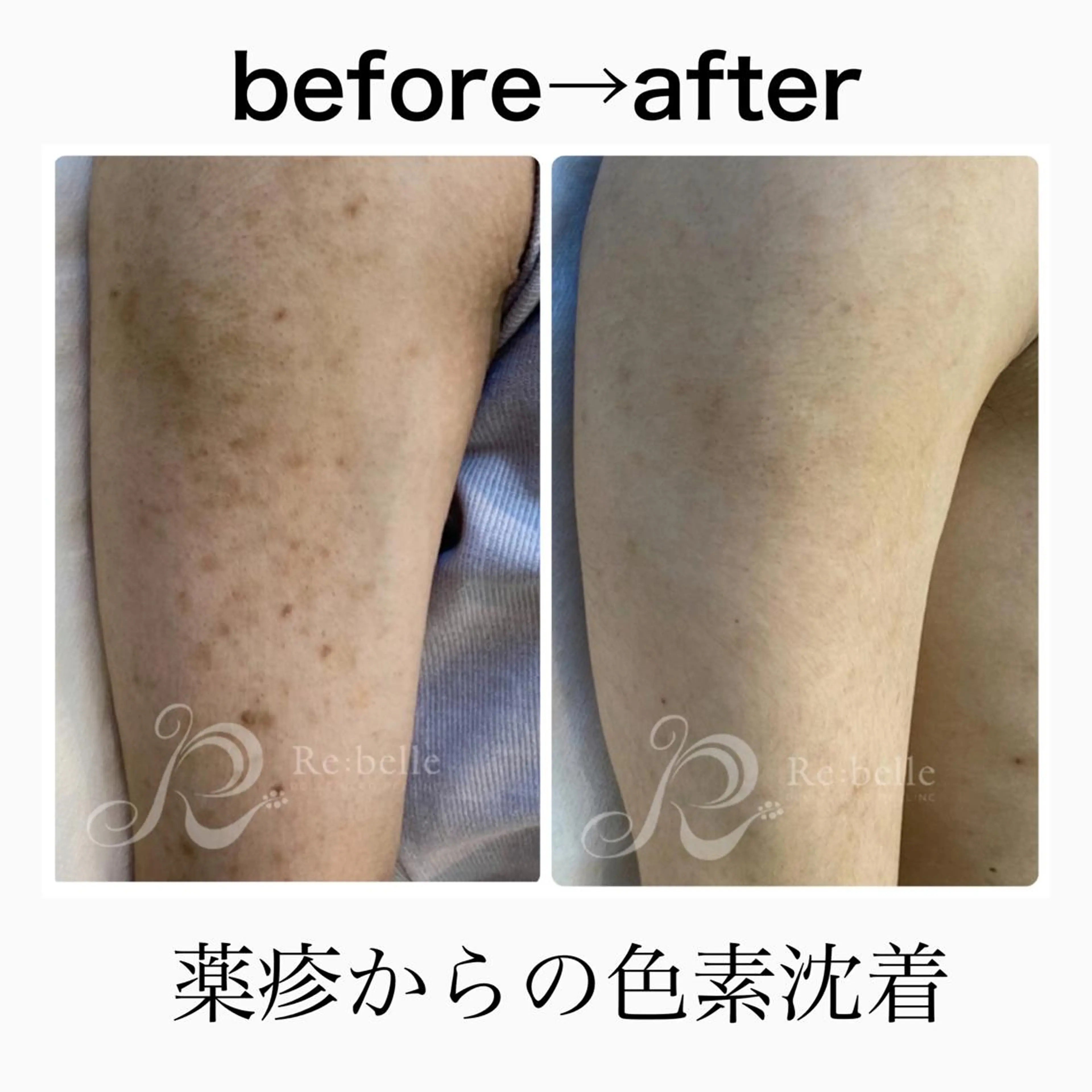 夏に向けて魅せれる二の腕に💪🤭❤️ニキビ・ニキビ跡/毛孔性苔癬などお悩みに合わせてケア🧚🏻‍♀️🌿の写真