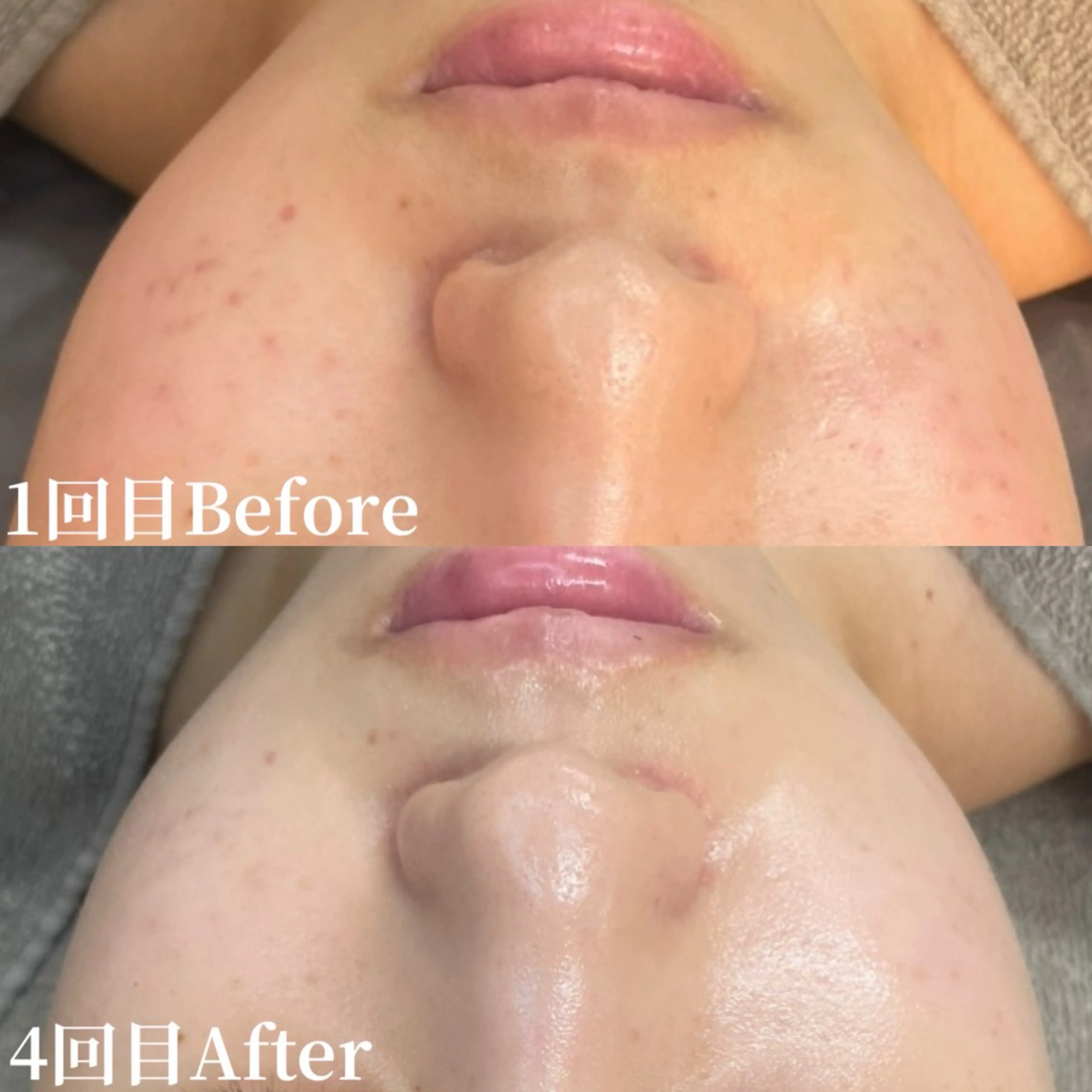 《リピーター様》肌質改善ハーブピーリング🌿‬の写真