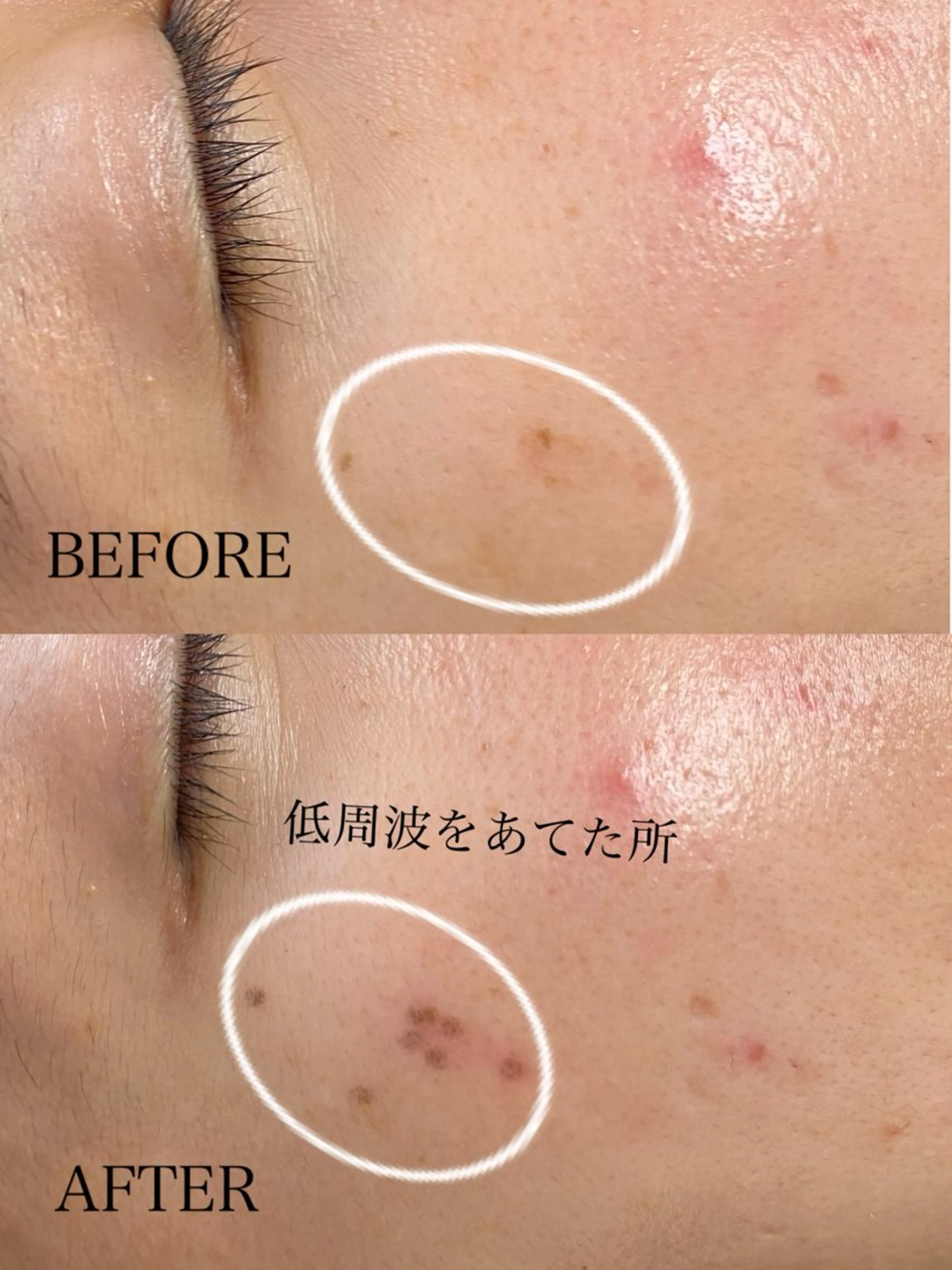 シミケア/ハーブピーリング/脱毛/小顔フェイシャル/ハーブ温浴　LAULEA所属・素肌をキレイに ラウレア🌼Hayaのエステ・リラクイメージ