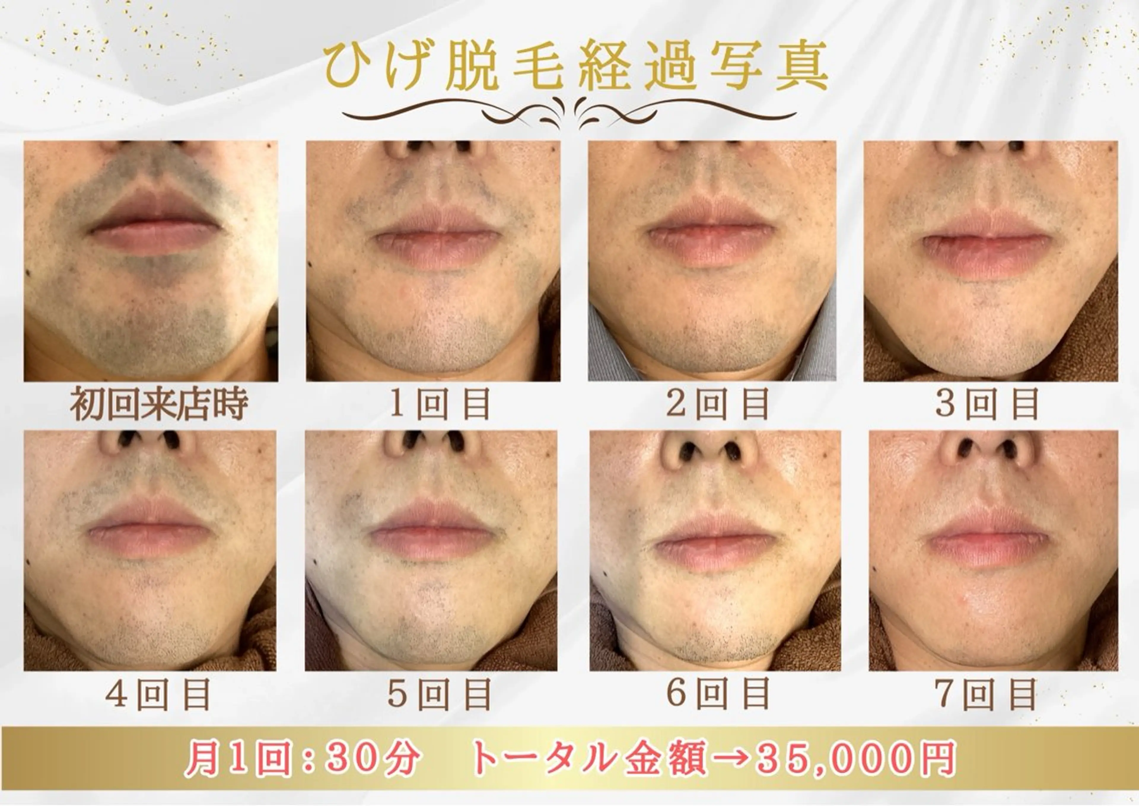 顔脱毛(両頬、鼻下、顎先、顎下、首)ひげ、メンズ脱毛の写真