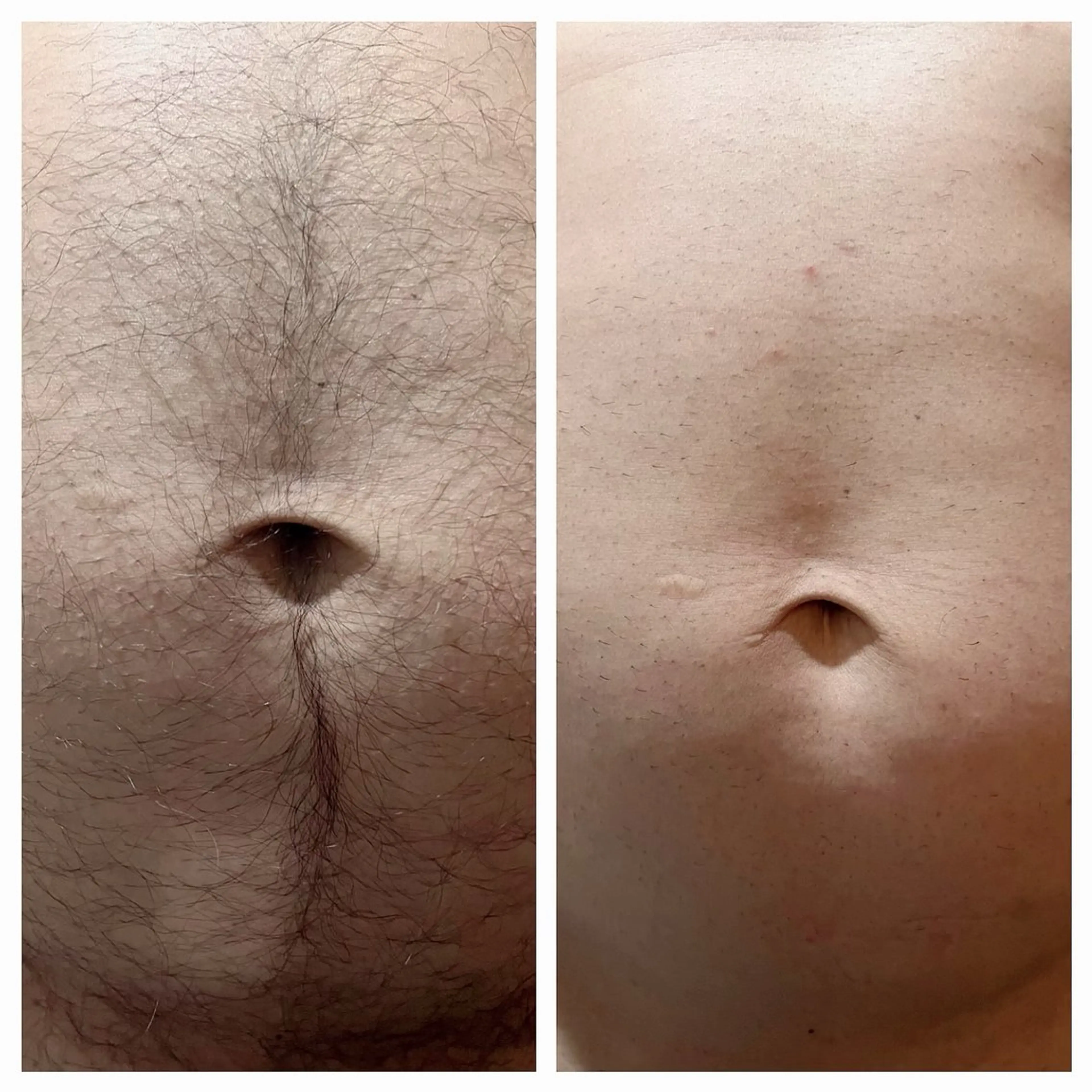 ご新規様限定✨メンズ脱毛(vio込み)の写真