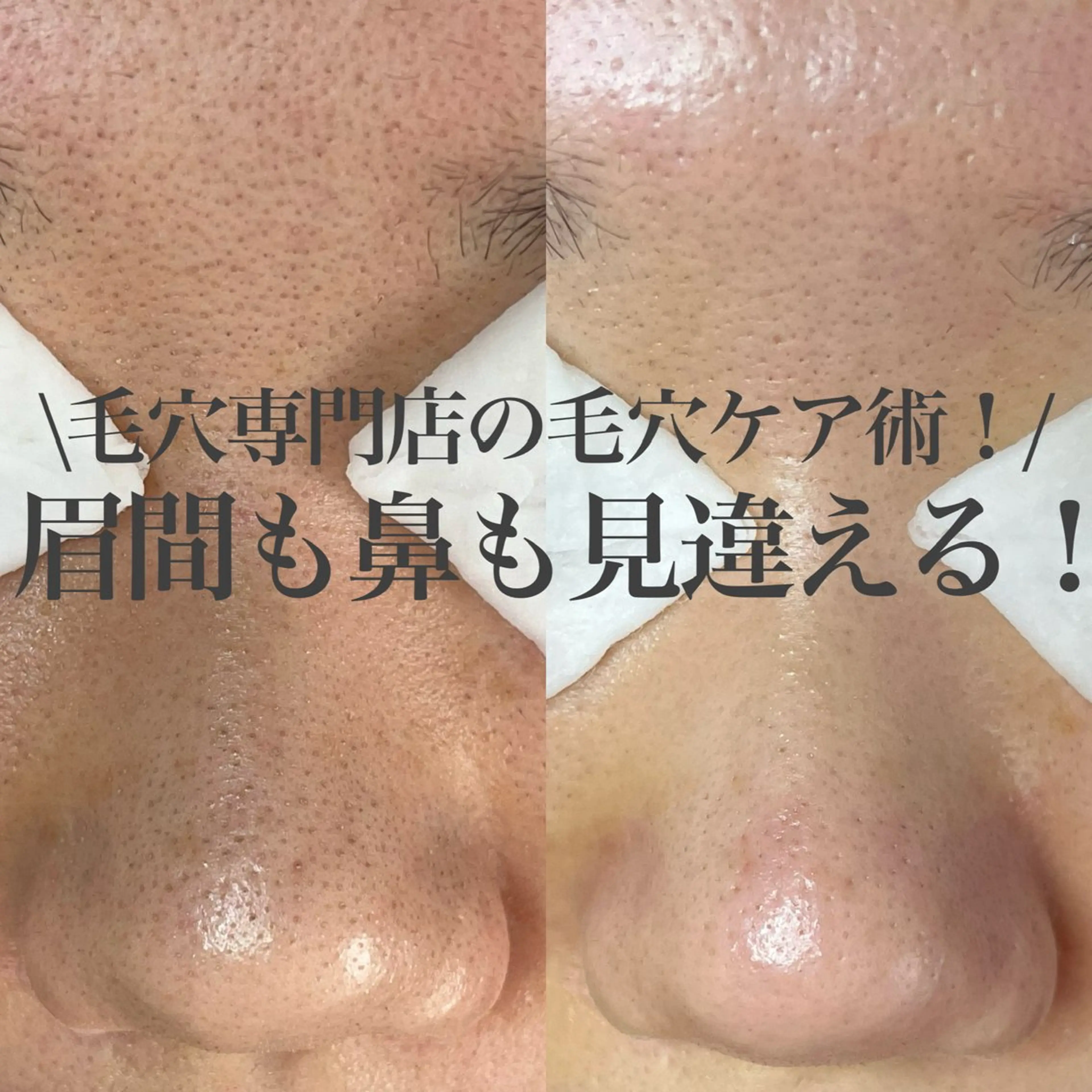 毛穴美人コース(80分)の写真