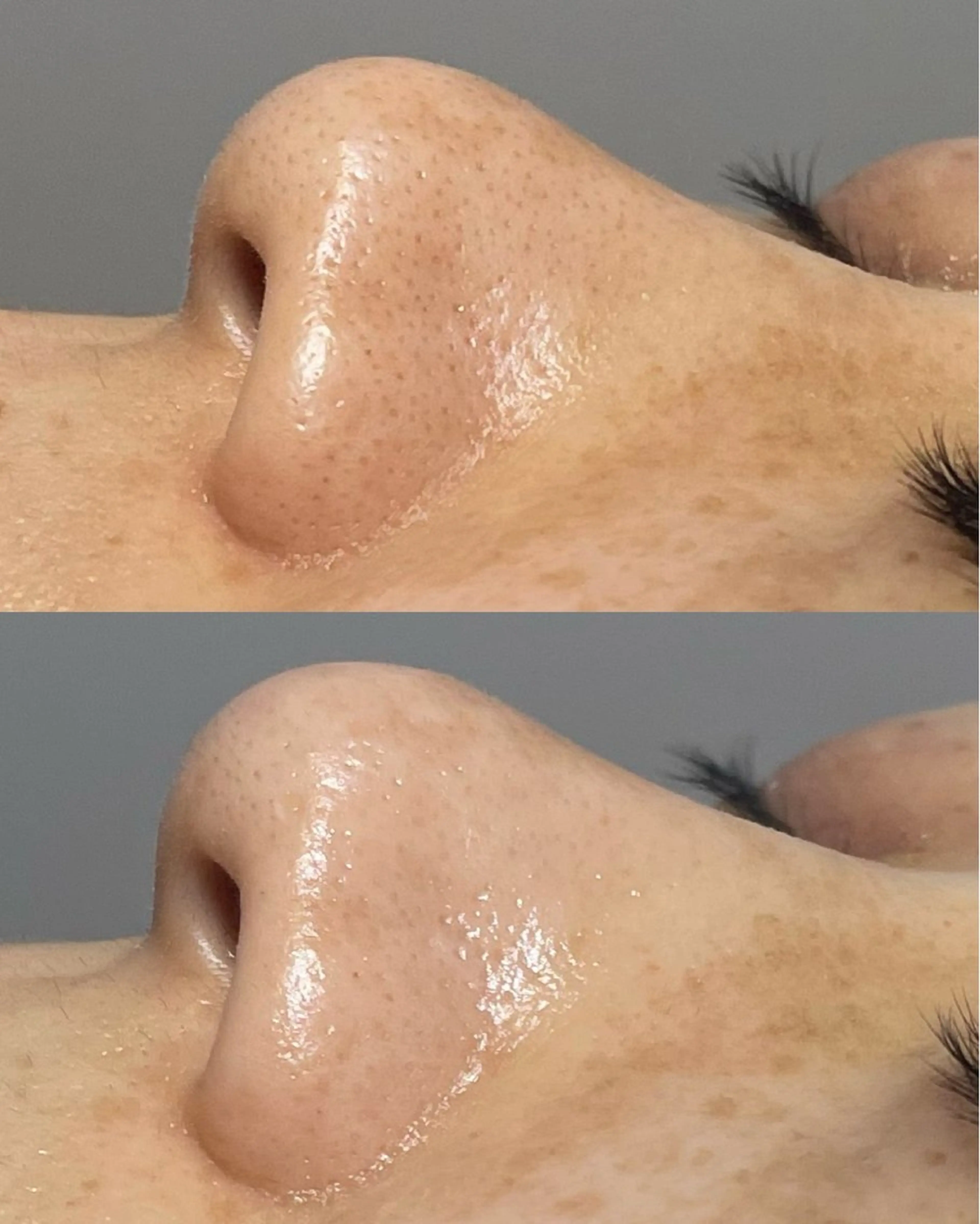 👶🏻【ツルツル毛穴洗浄コース】👶🏻詰まり・黒ずみゼロへ!毛穴すっきり、透明感あふれる素肌へ🫧👃✨の写真