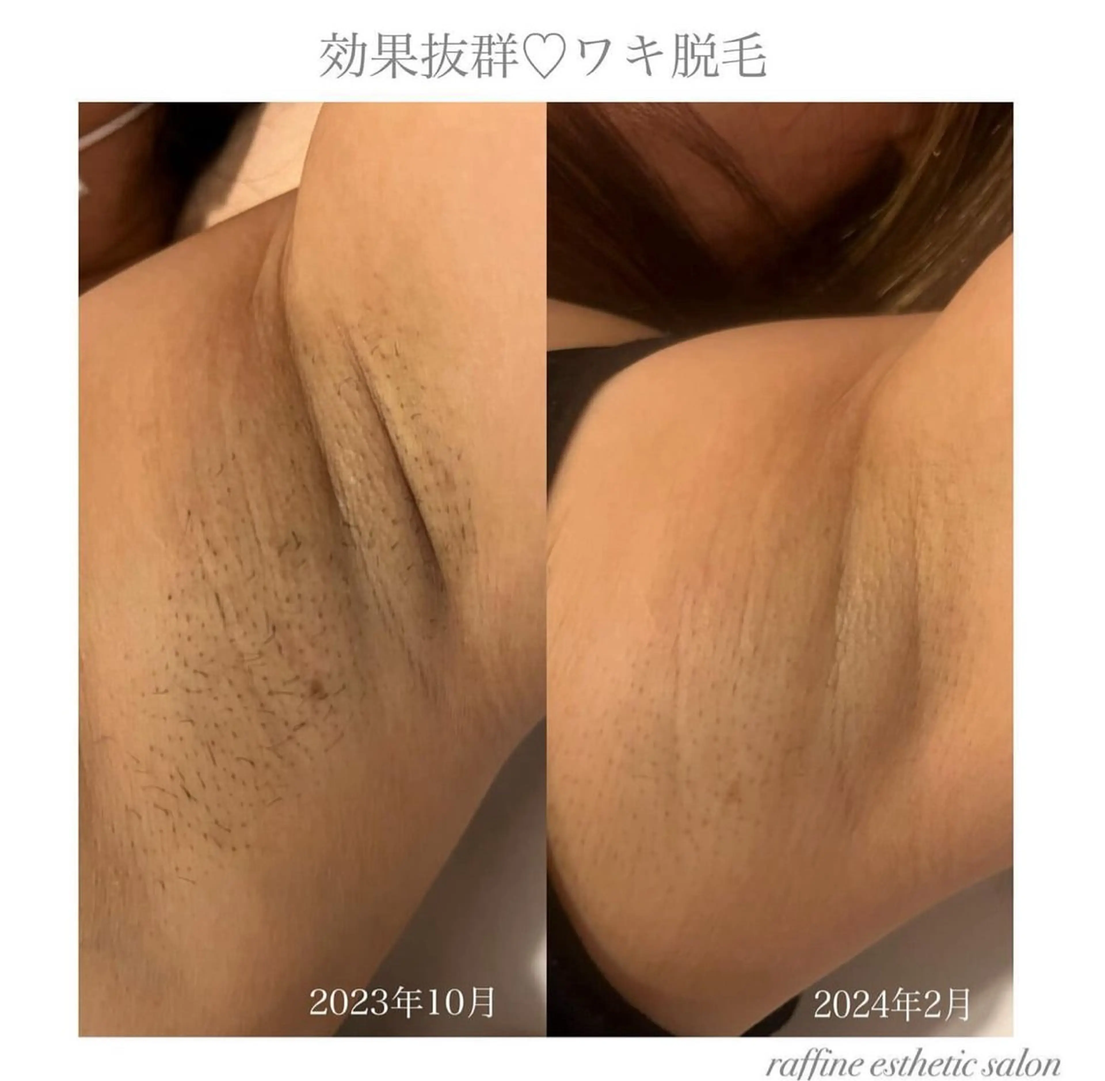 raffine  esthetic salon所属・🌻raffine 脱毛/まつ毛/ヘアーのエステ・リラクイメージ