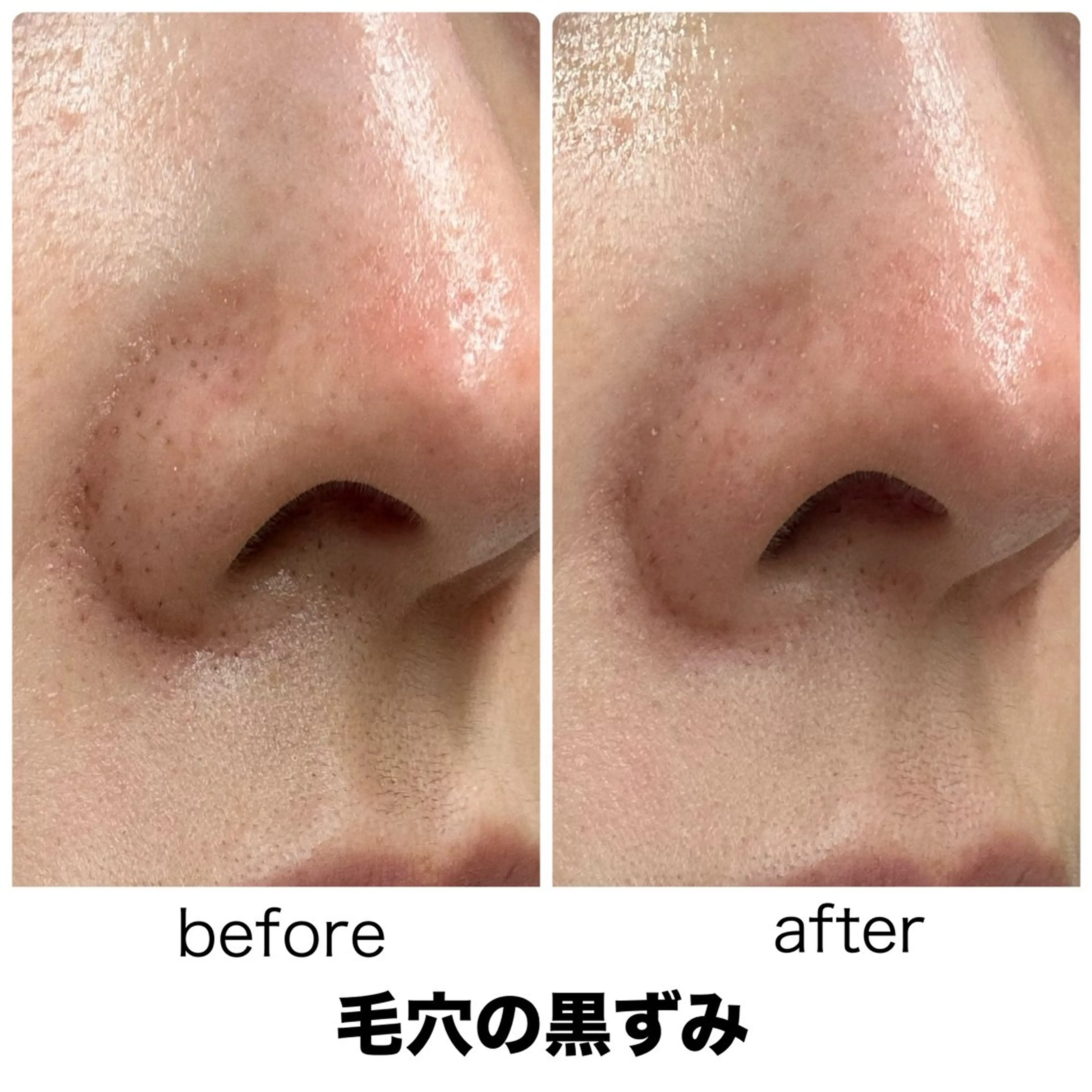 【黒ずみ・詰まり毛穴】ハーブピーリング🌿本気の毛穴ケア✨ つるんと水光肌へ♡剥離なし、ダウンタイムなし、敏感肌◎の写真