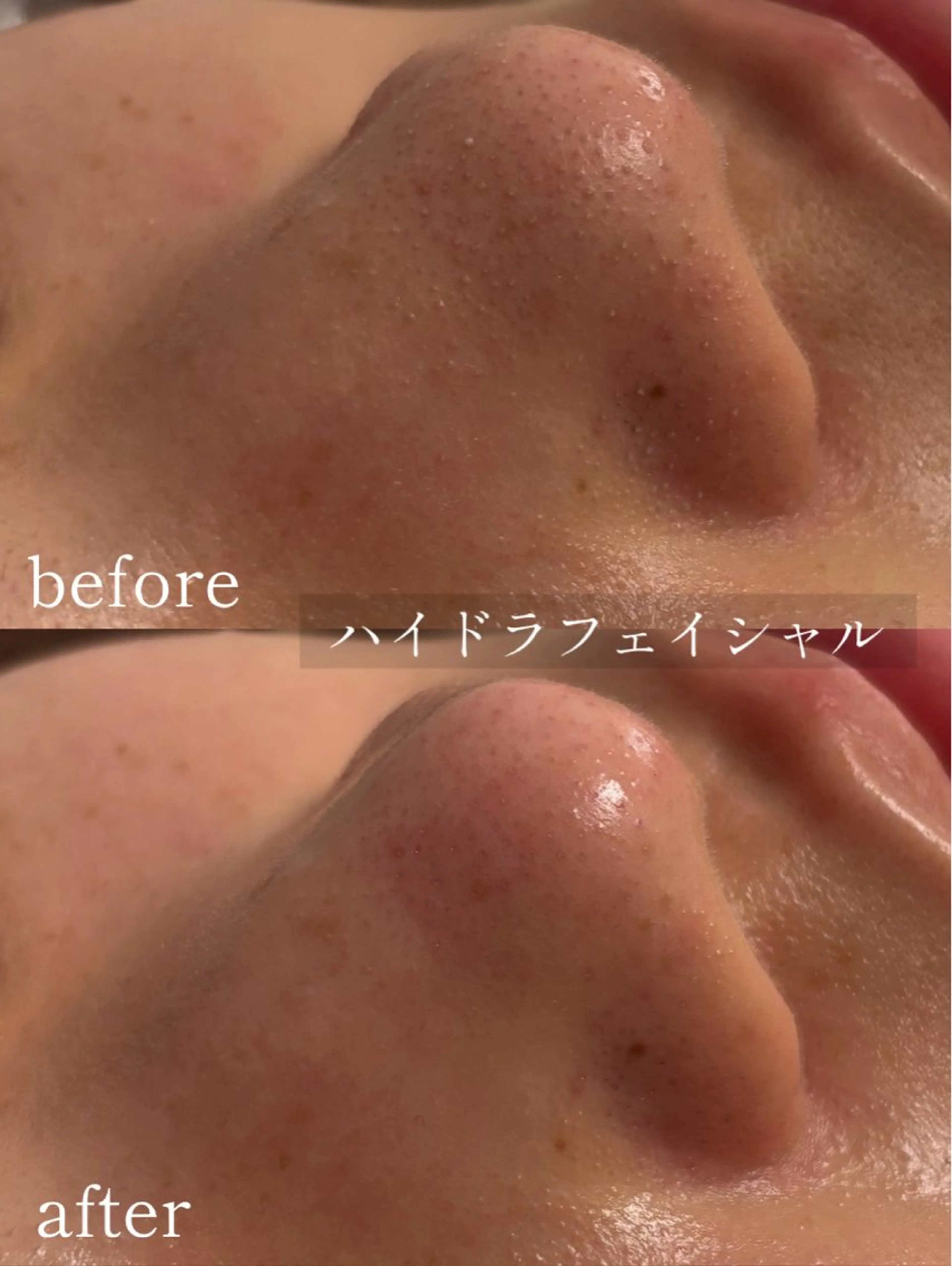 【11月末迄ご予約限定】大人気☆ハイドラフェイシャル/徹底毛穴洗浄でメイクノリアップ◎メンズもOK!の写真