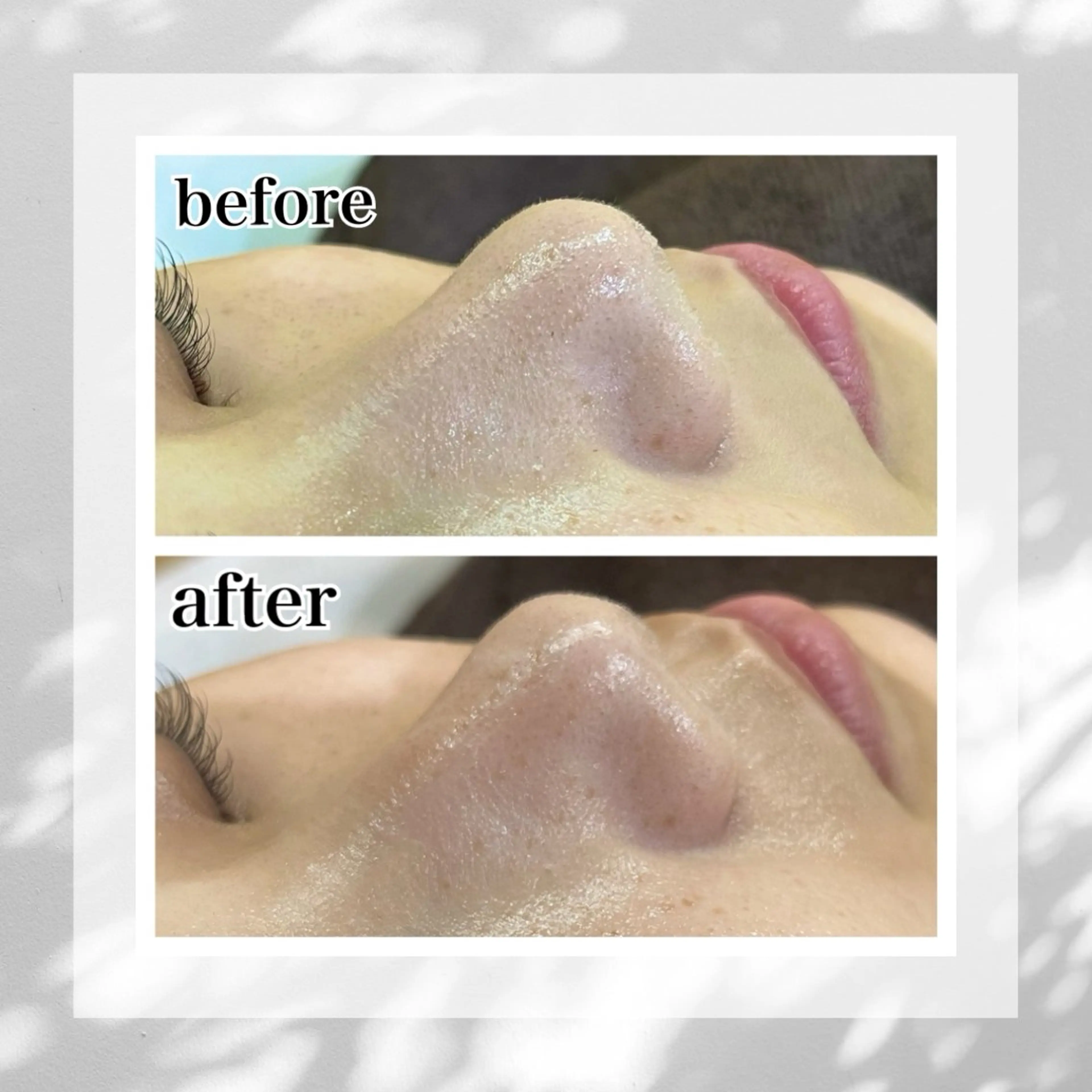 1日1名 【いちご鼻をなんとかしたい方限定】鼻のみ！毛穴洗浄お試し20分の写真