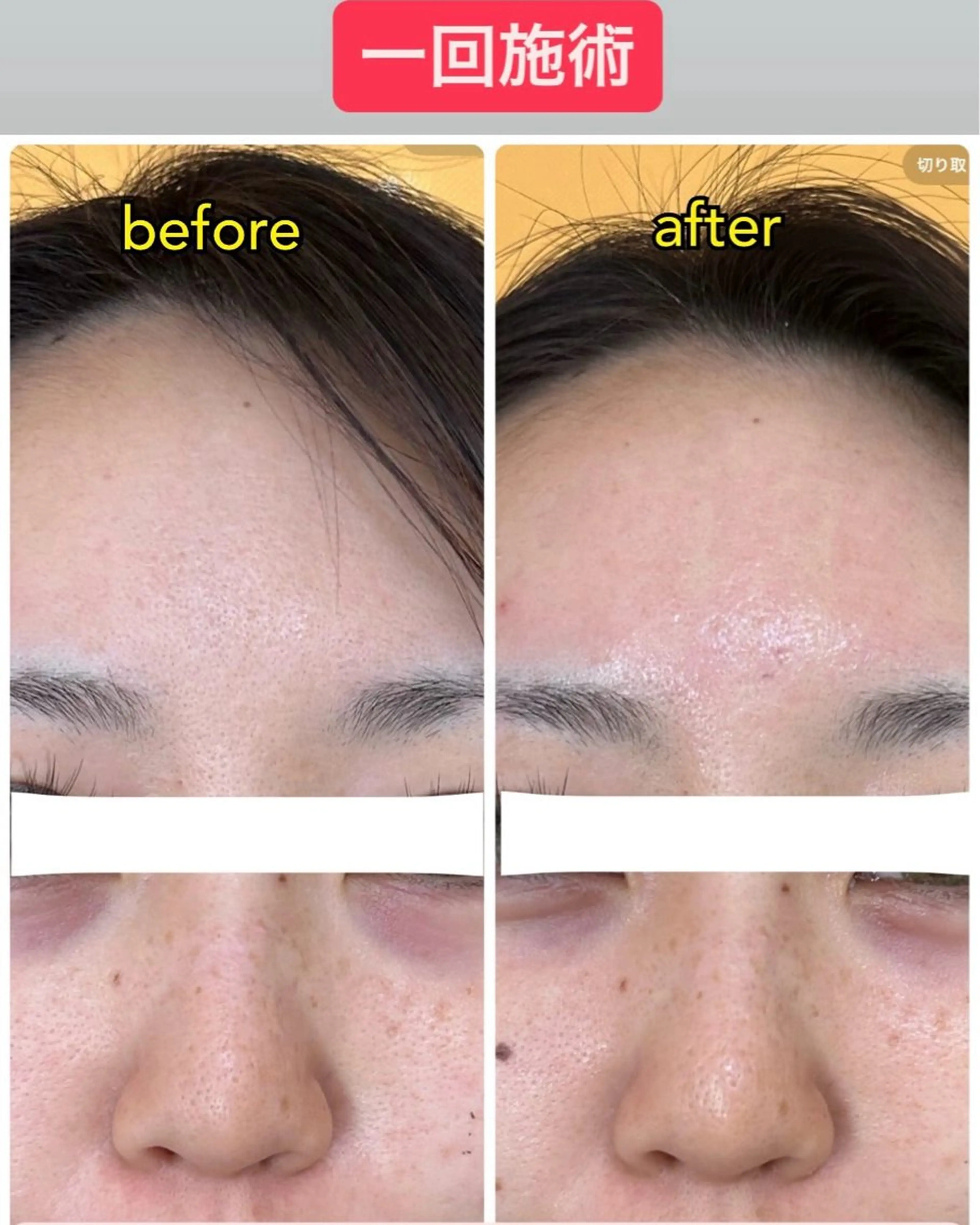 お正月で荒れたお肌をケア！お肌もっちもちぷるぷる！一万円分の美容液パックを使ったドライヘッドスパ！骨盤矯正つき！の写真