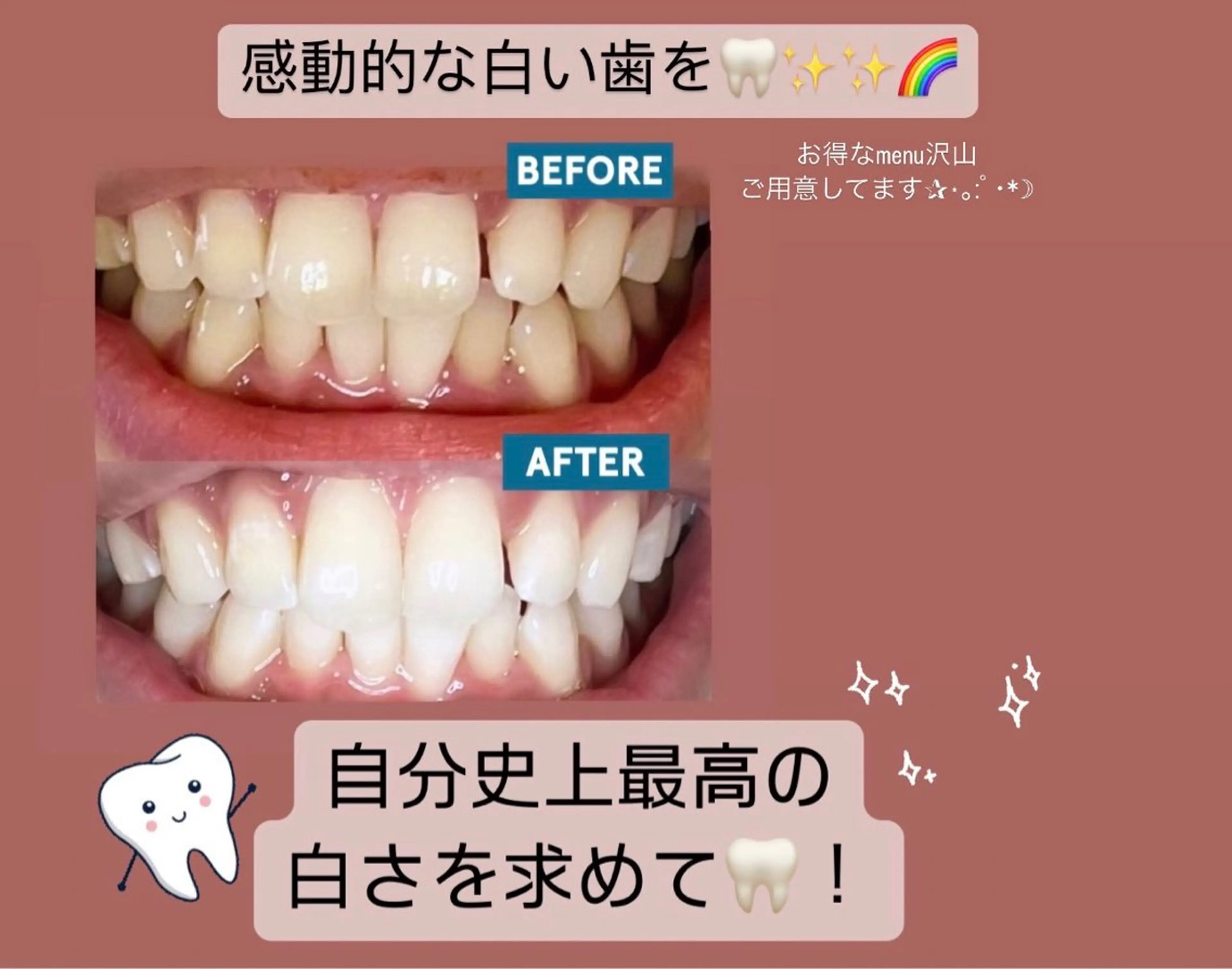 セルフホワイトニング単品15分×3回→1来店🦷✧︎✨現金のみ💸の写真