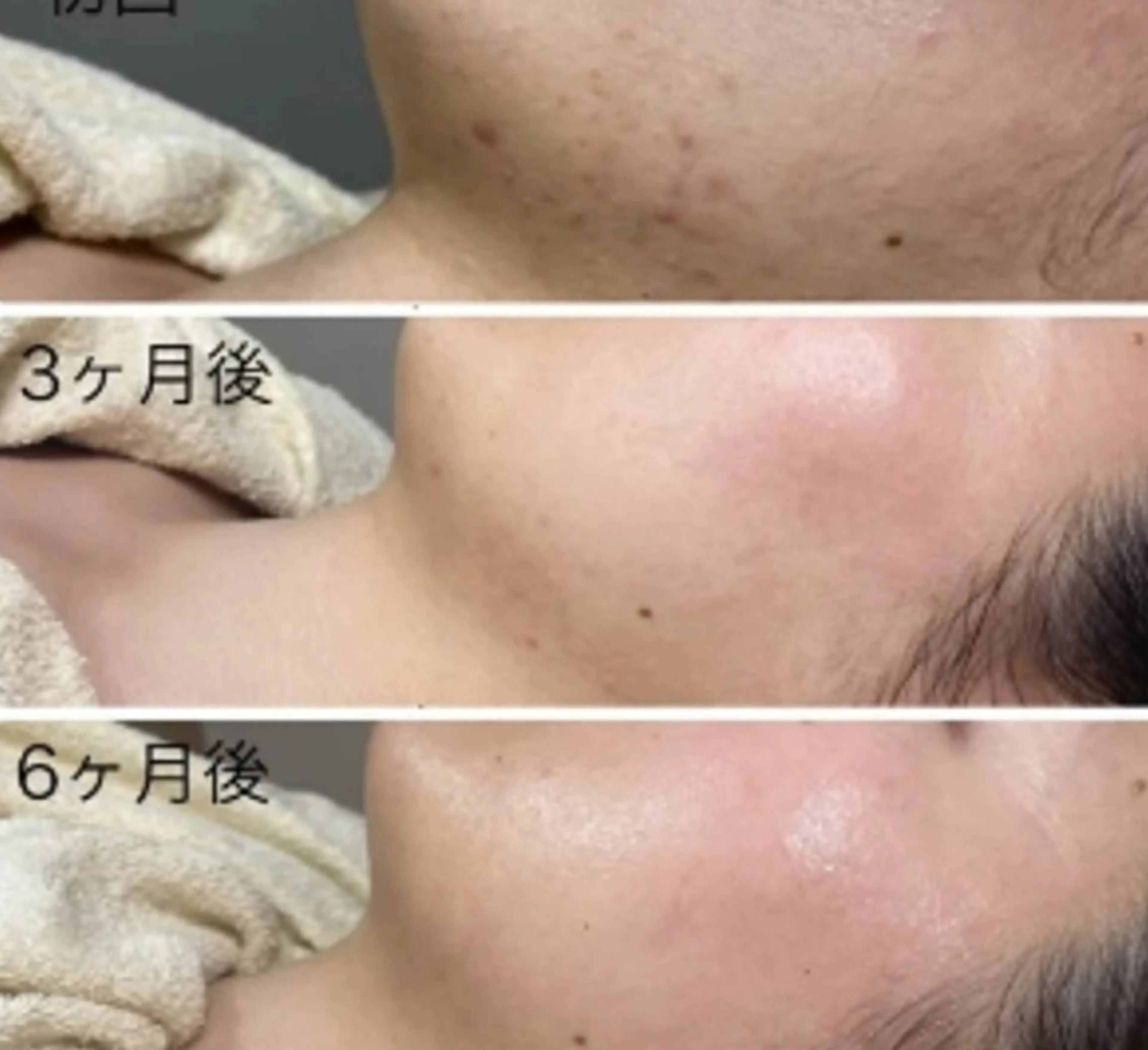 プラズマでお肌の土台づくり。人幹細胞美容液を導入❗肌細胞までよみがえらせます【現金のみ】の写真