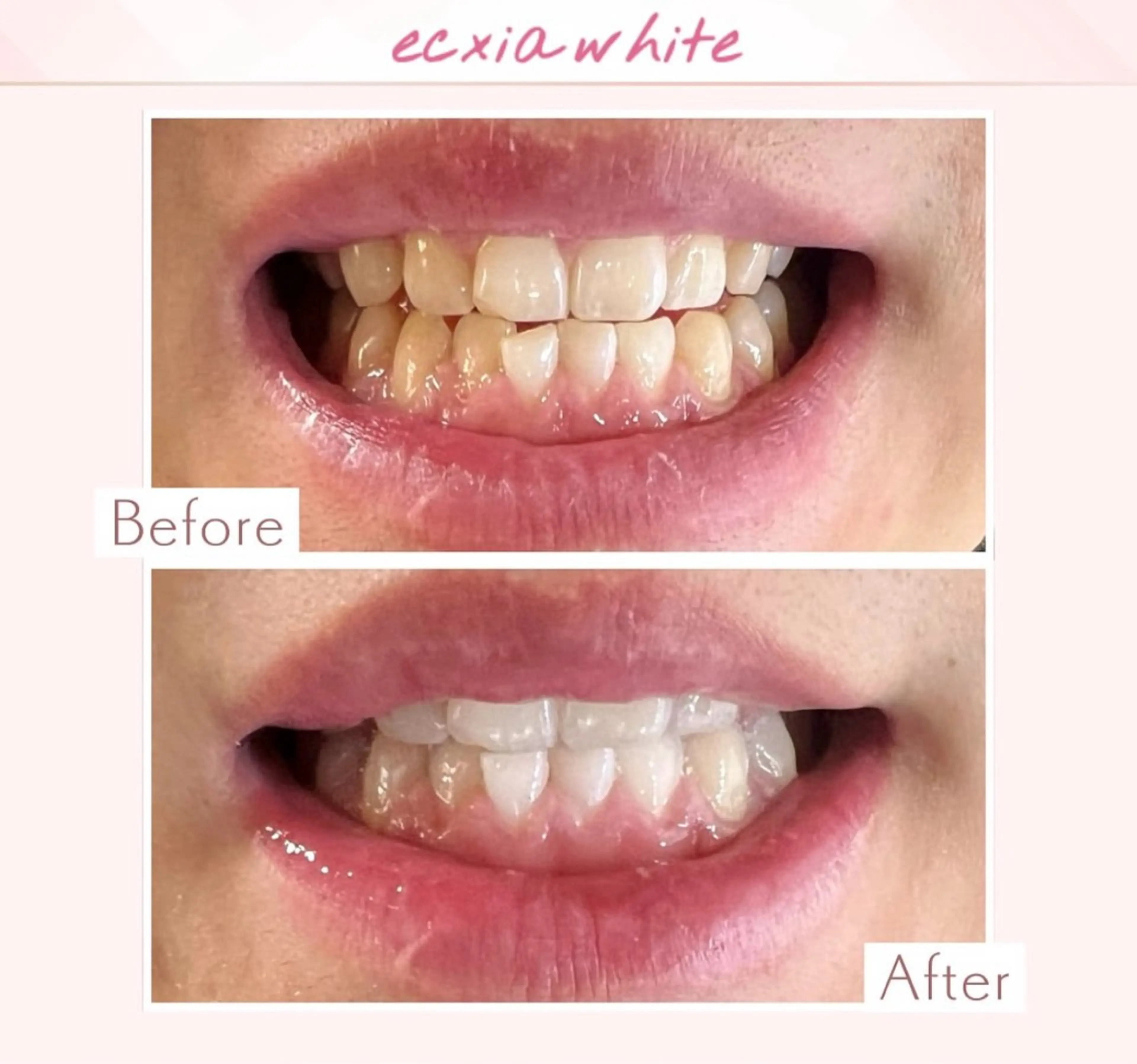 エクシアホワイト調布所属・umi❤︎ ホワイトニングのその他イメージ