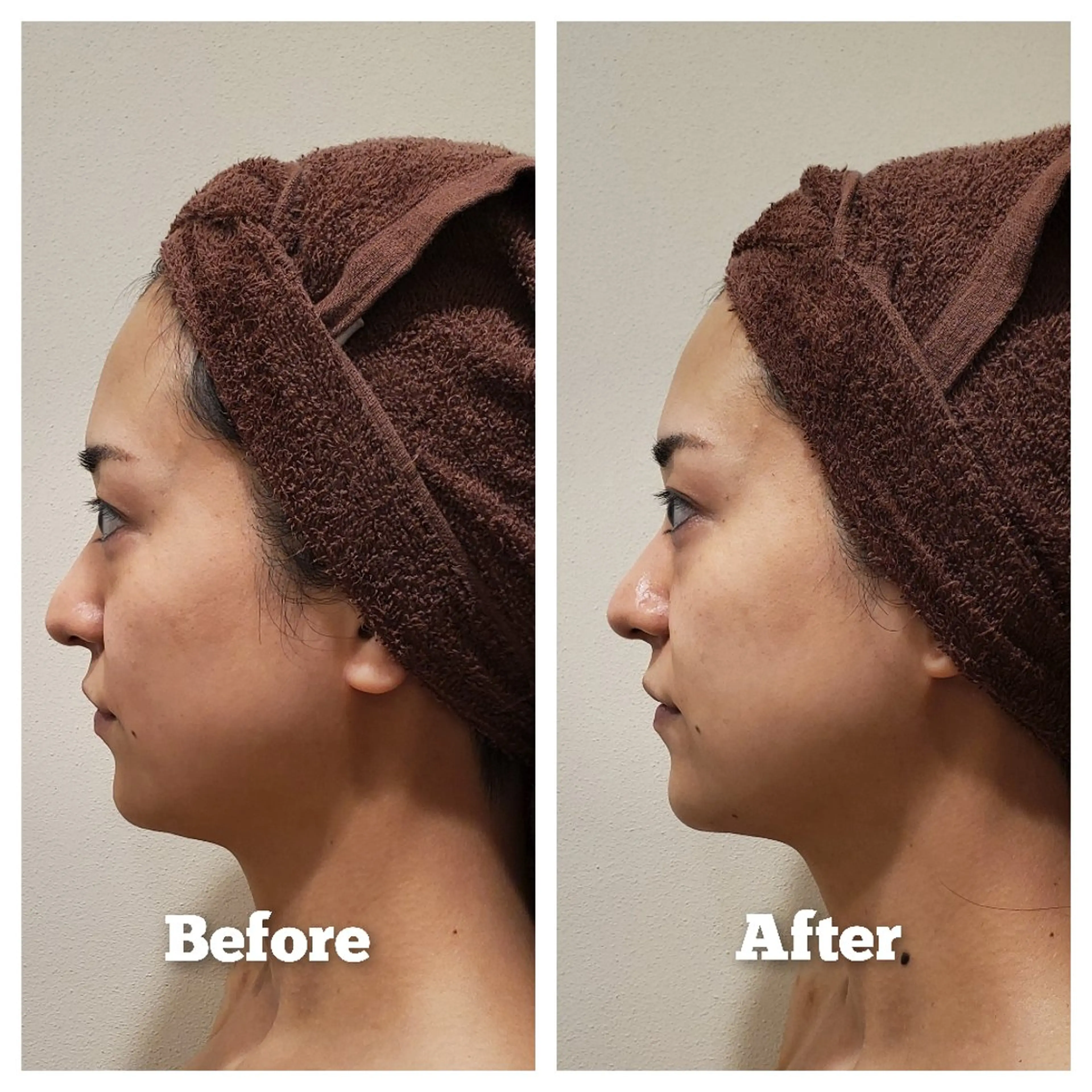 【エイジングケア】年齢肌のお悩みに🌸キュッと小顔!細胞からしっとり潤うヒト幹細胞フェイシャル90分の写真