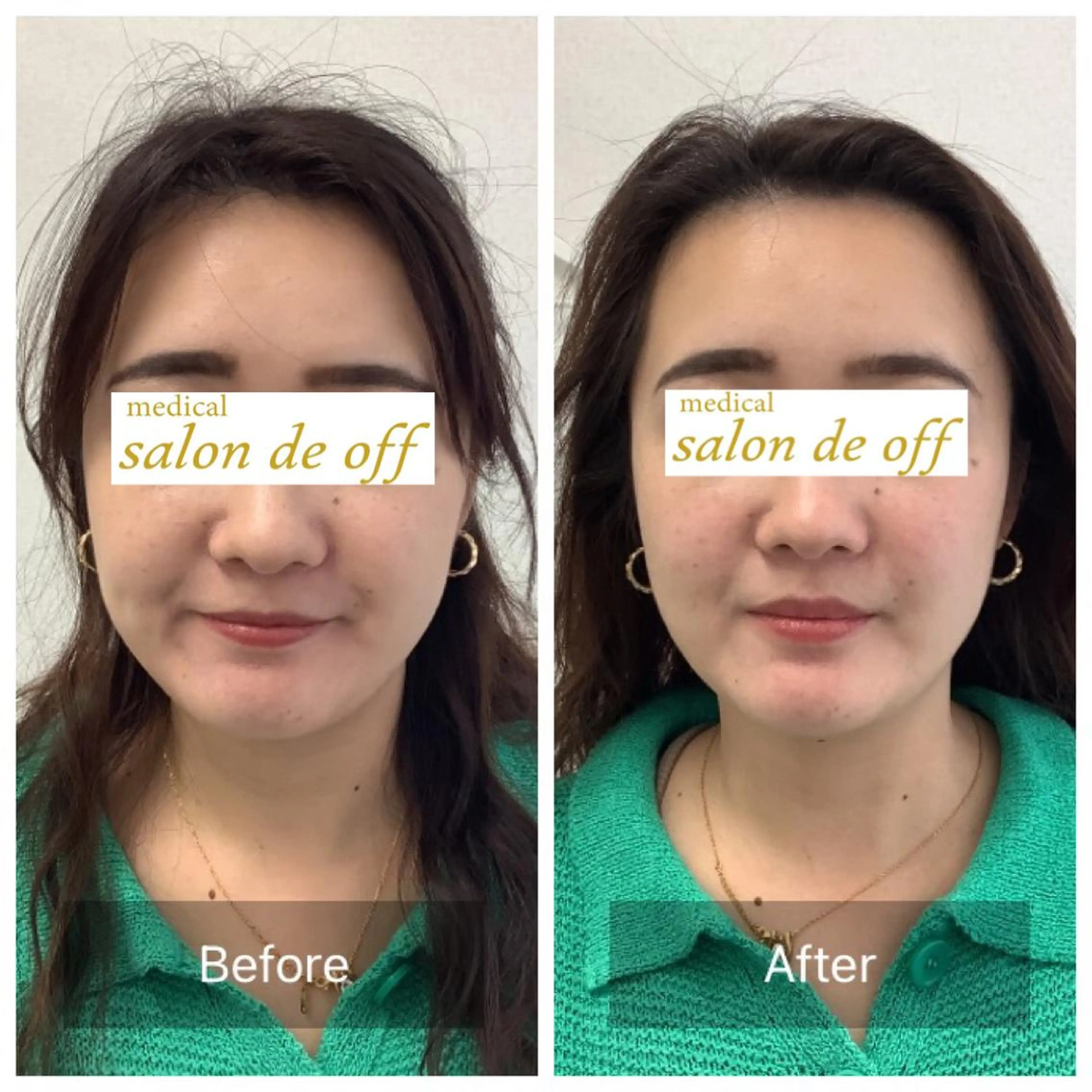 エステ リラク メディカルサロンドオフ所属・ハリサロンドオフ 美容鍼灸×小顔整体のエステ・リラクイメージ