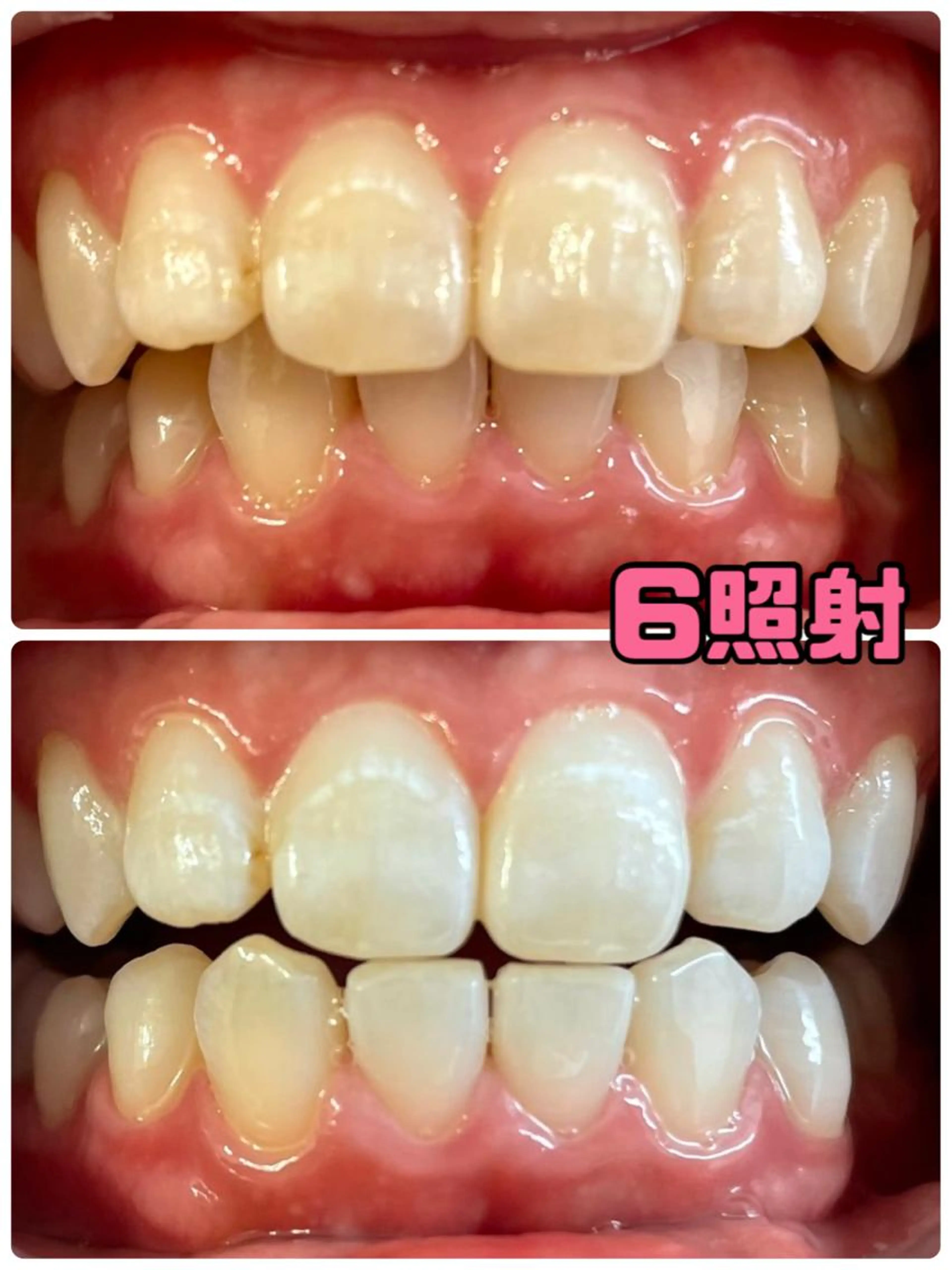 ハイグレードホワイトニング🦷👑8分×6回照射🥰一気に白くなりたい方へ‼️💕全国最安値🦷芸能人御用達サロン💍の写真