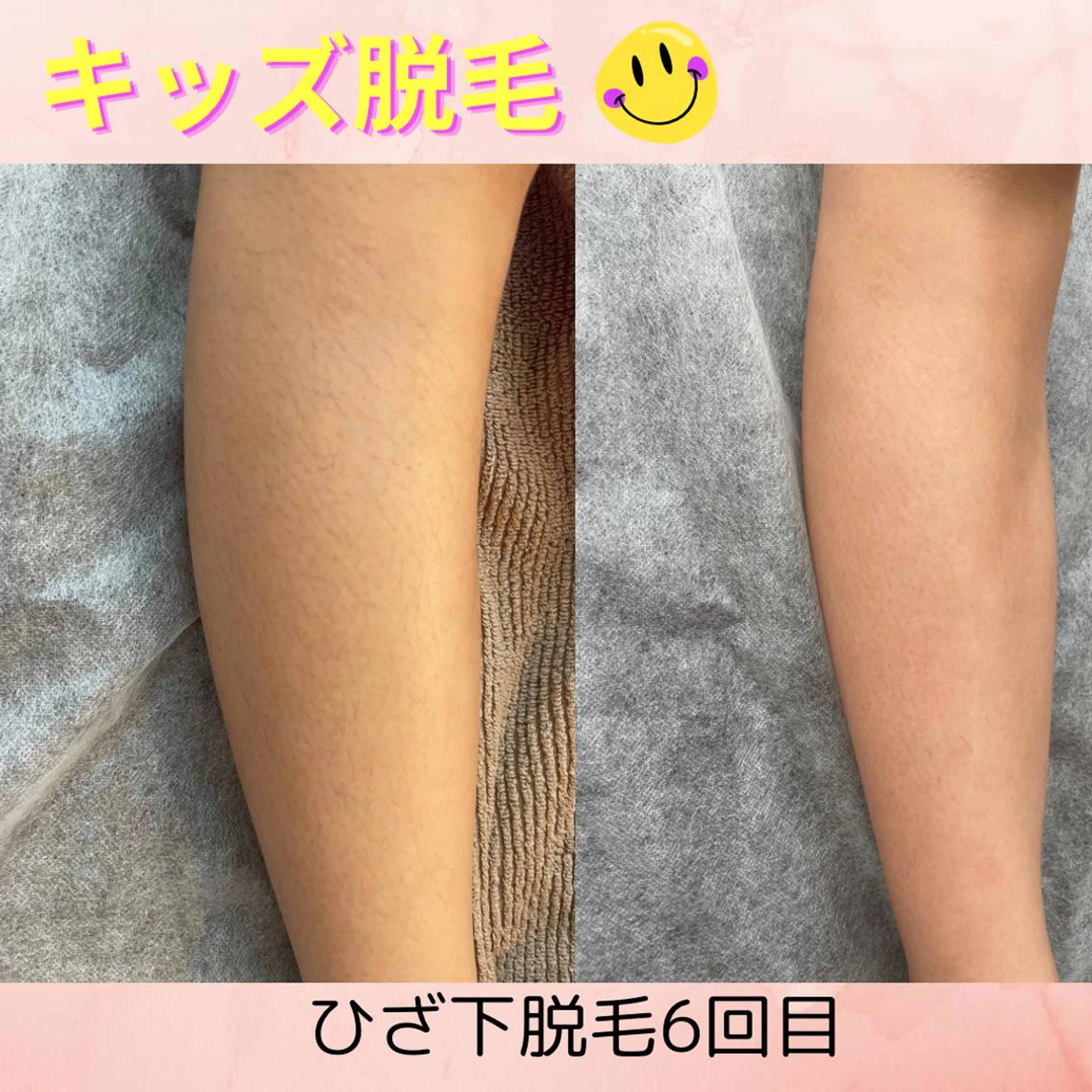 キッズ 脱毛 Pono所属・Pono （ポノ）のその他イメージ