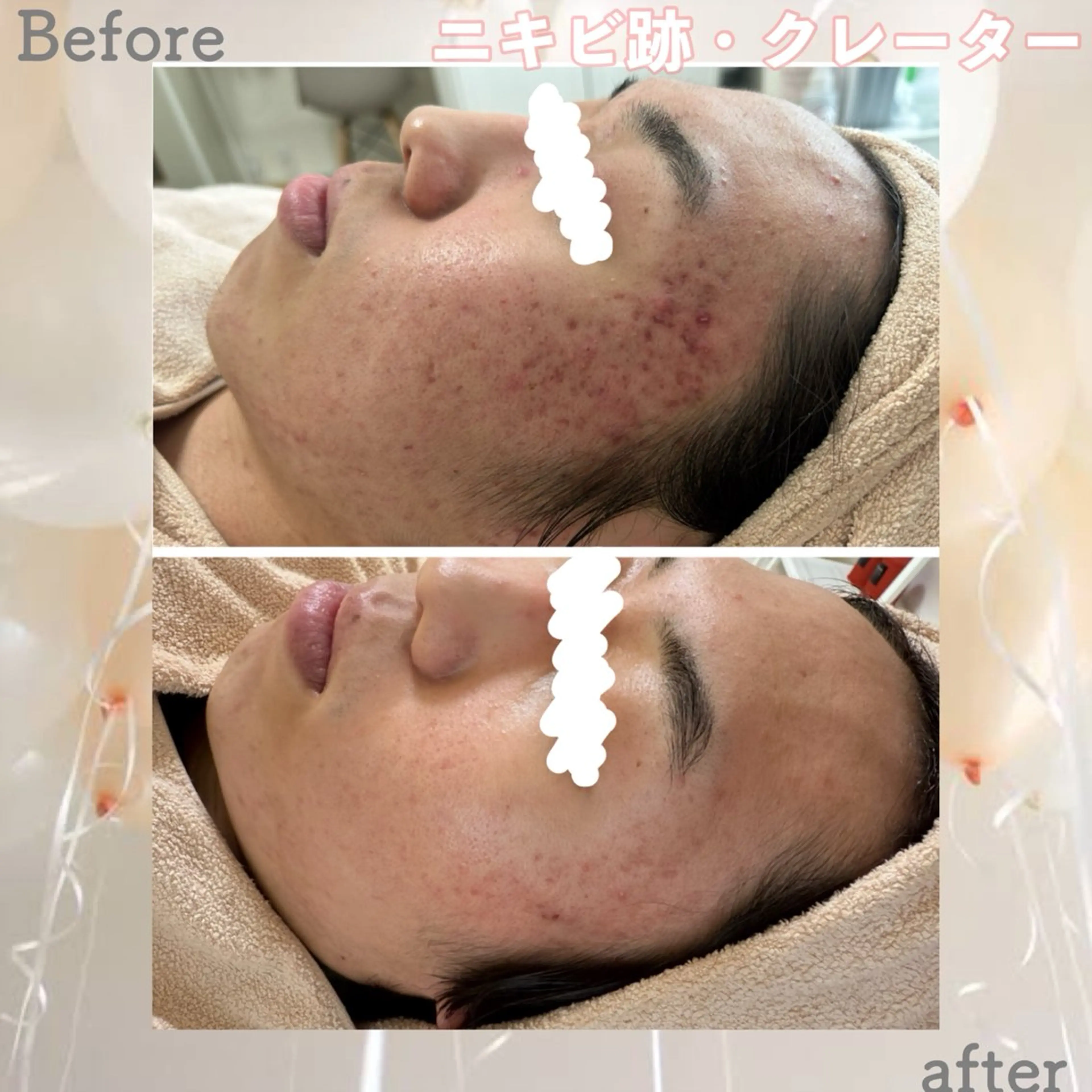 メンズ エステ ニキビ&跡改善サロン オーナー光木のエステ・リラクイメージ