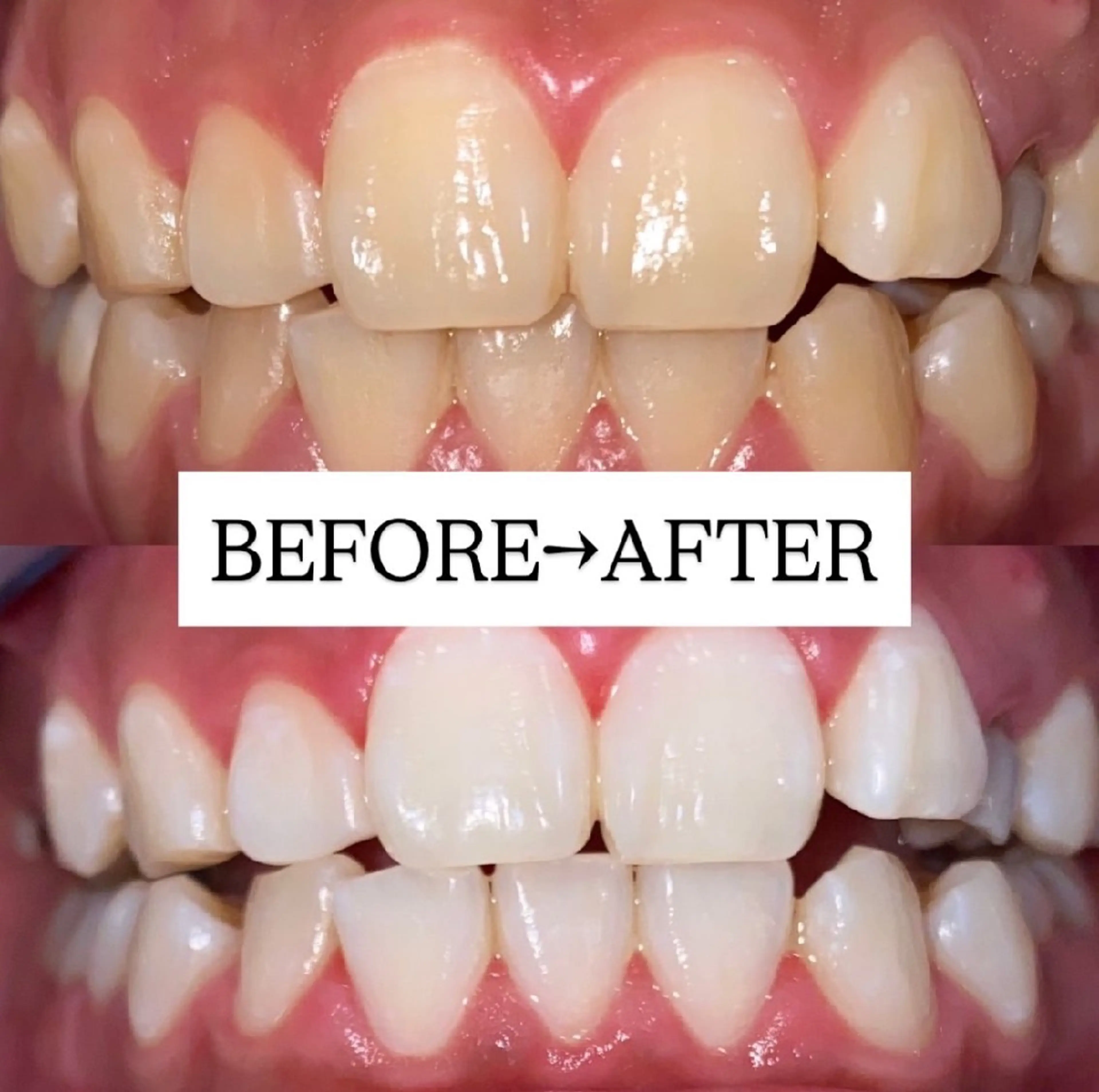 【minimo特別セール価格★】お試し♪速攻効果実感！美白ホワイトニング20分×2回照射¥1,500の写真